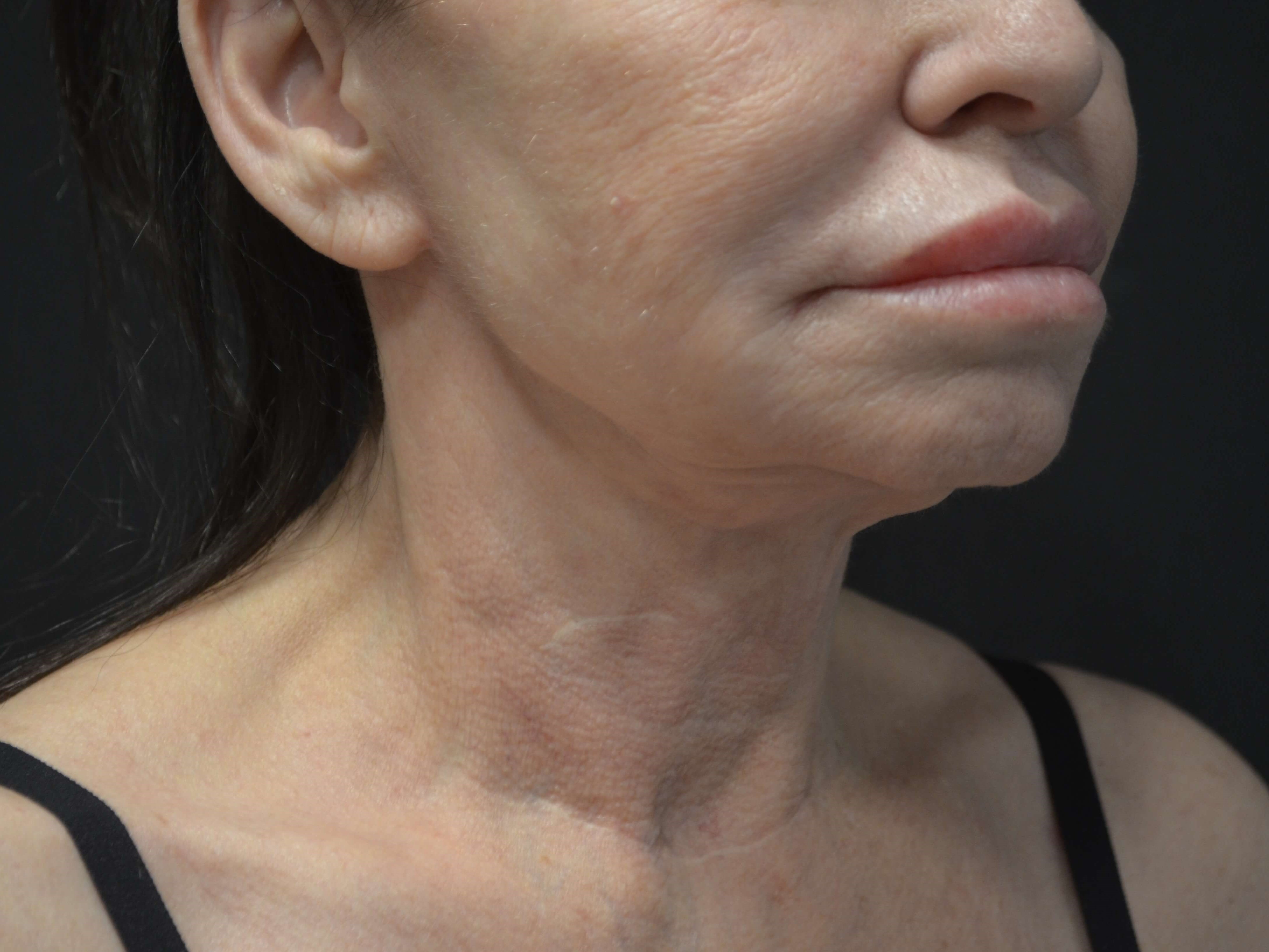 Lower Face and Neck Lift Before