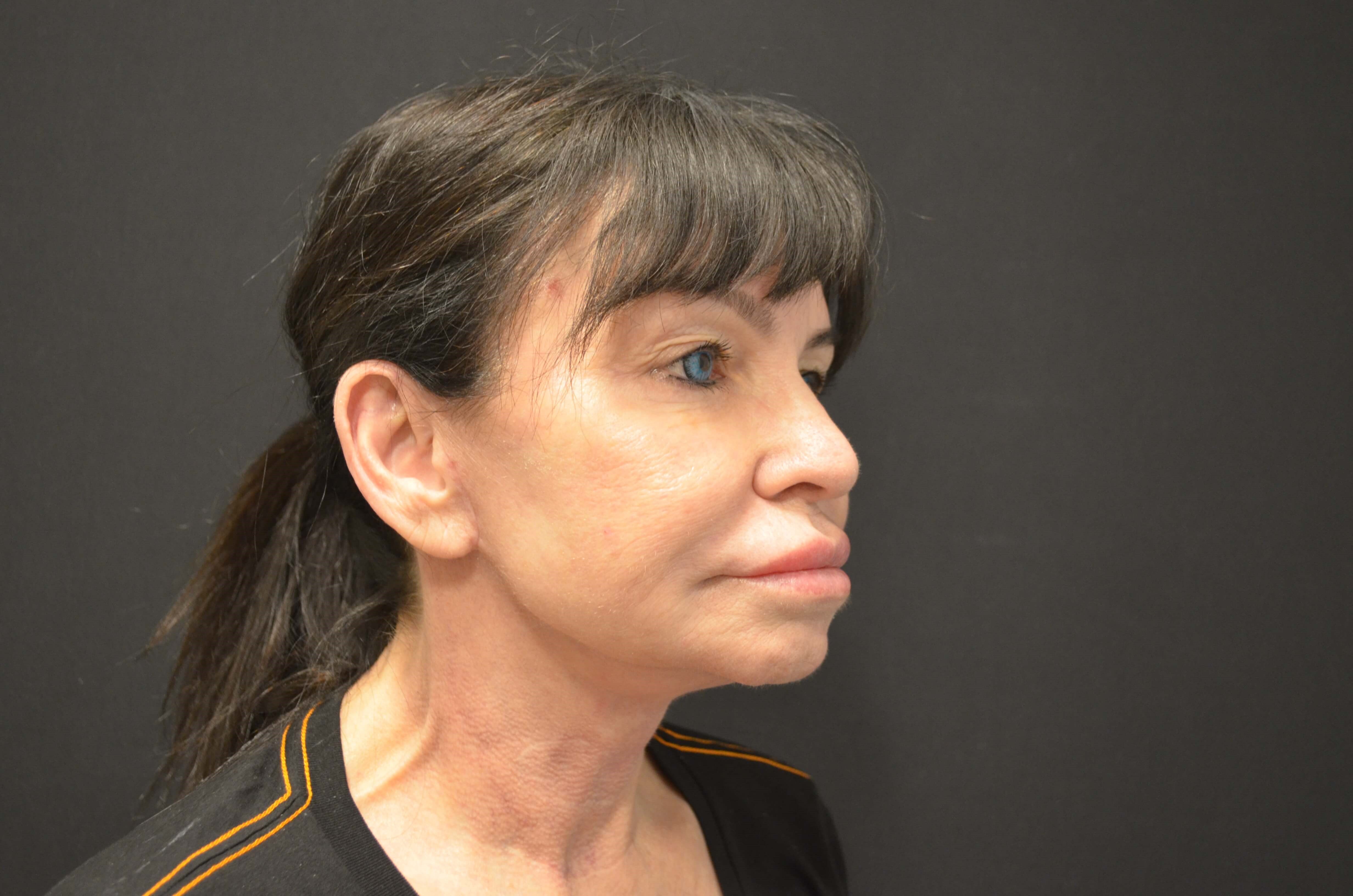Lower Face and Neck Lift After