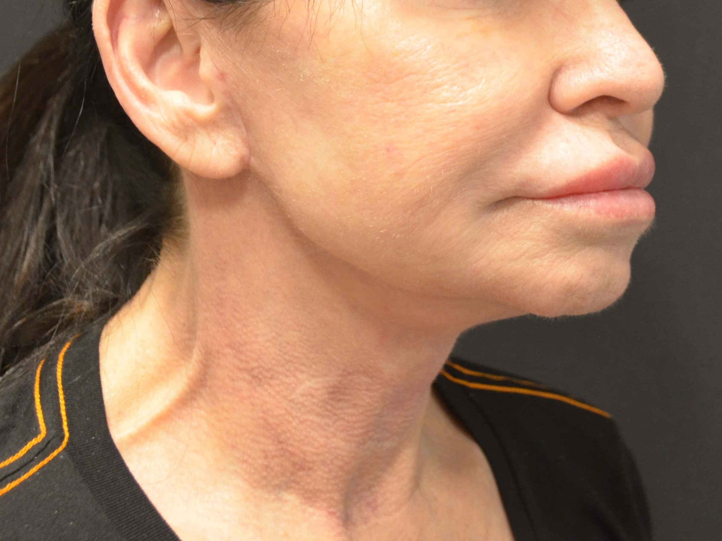 Lower Face and Neck Lift After