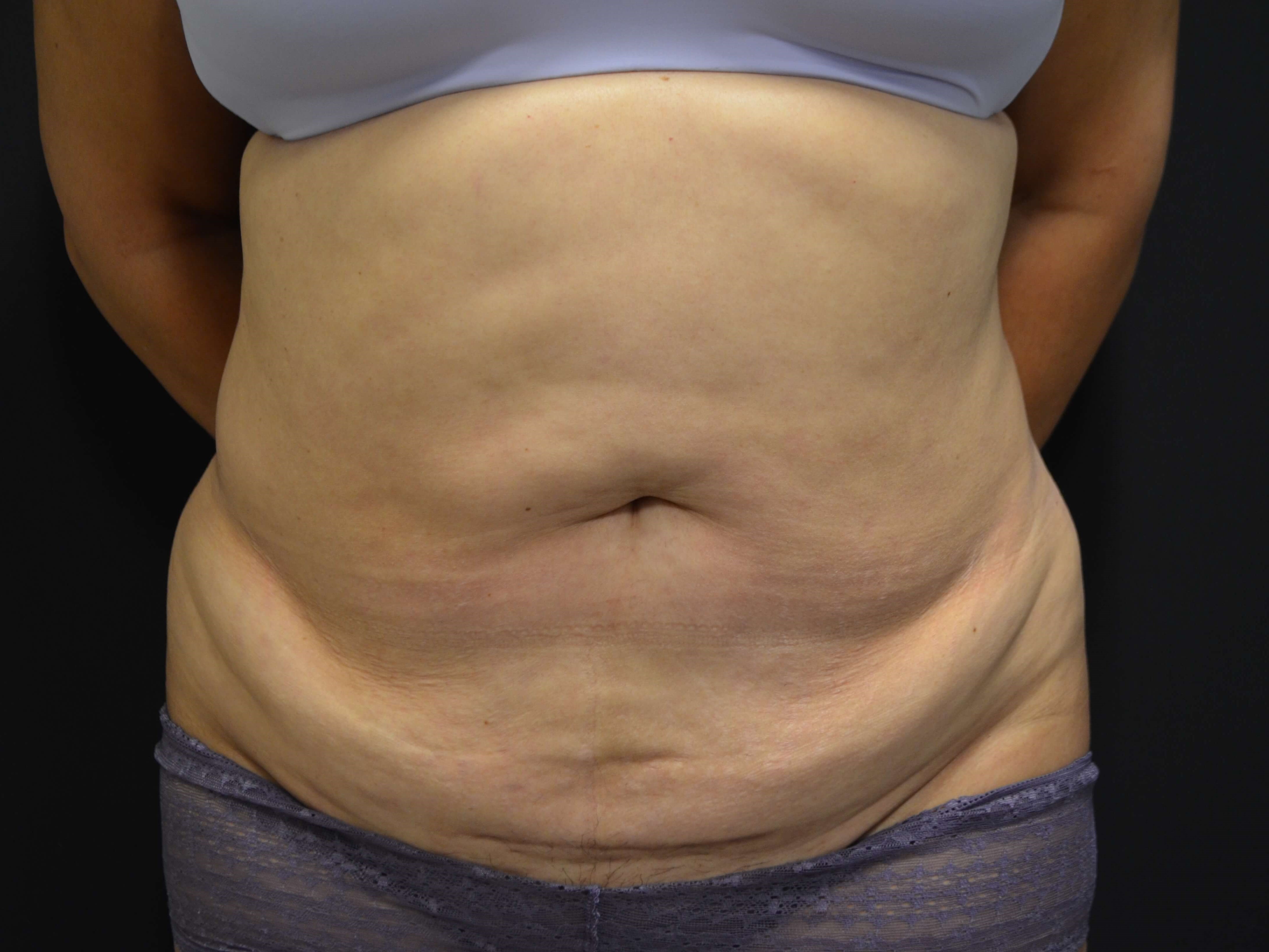 Mommy Makeover-Hinsdale, IL Before