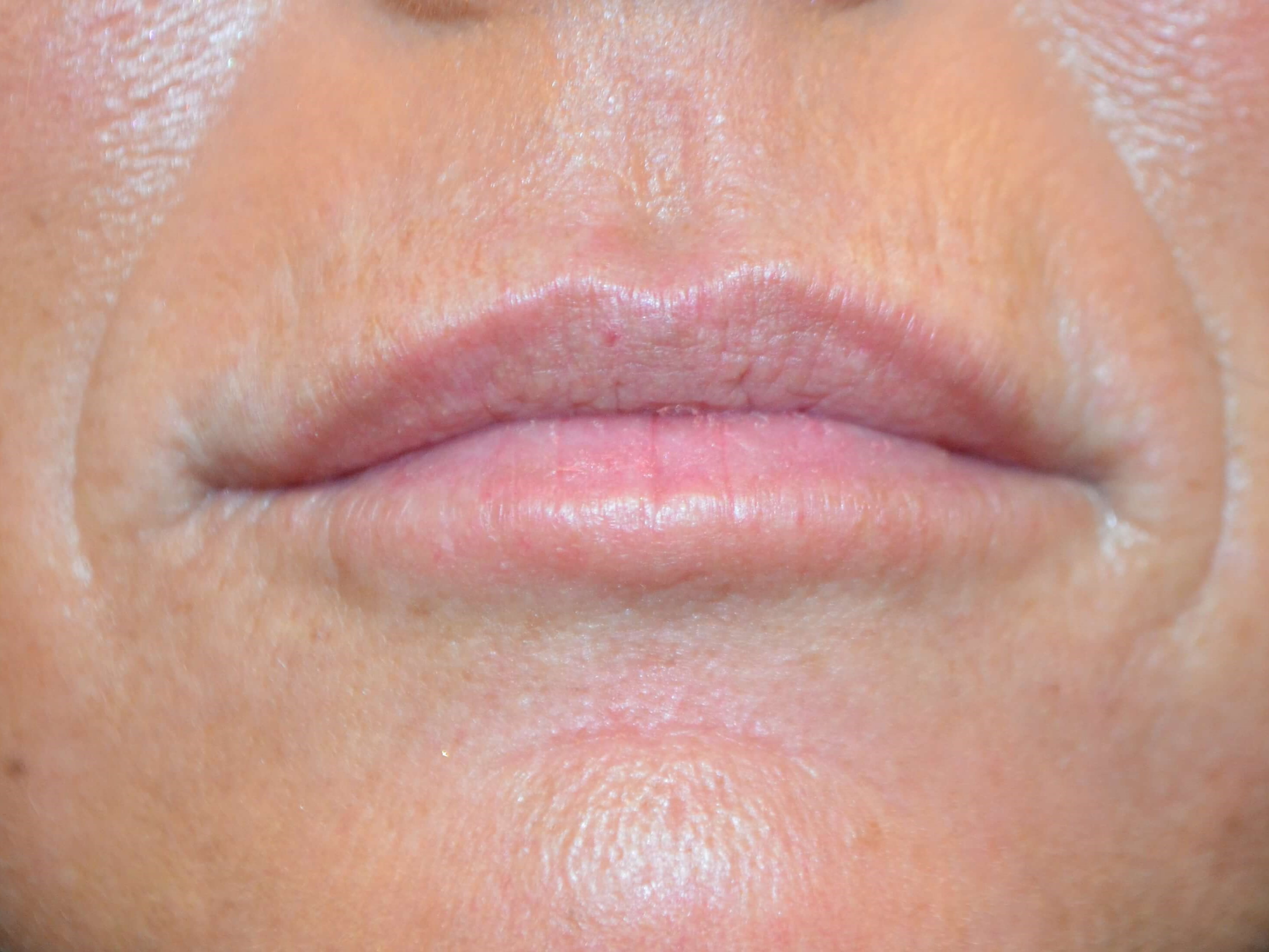 Lip Enhancement-Juvederm After