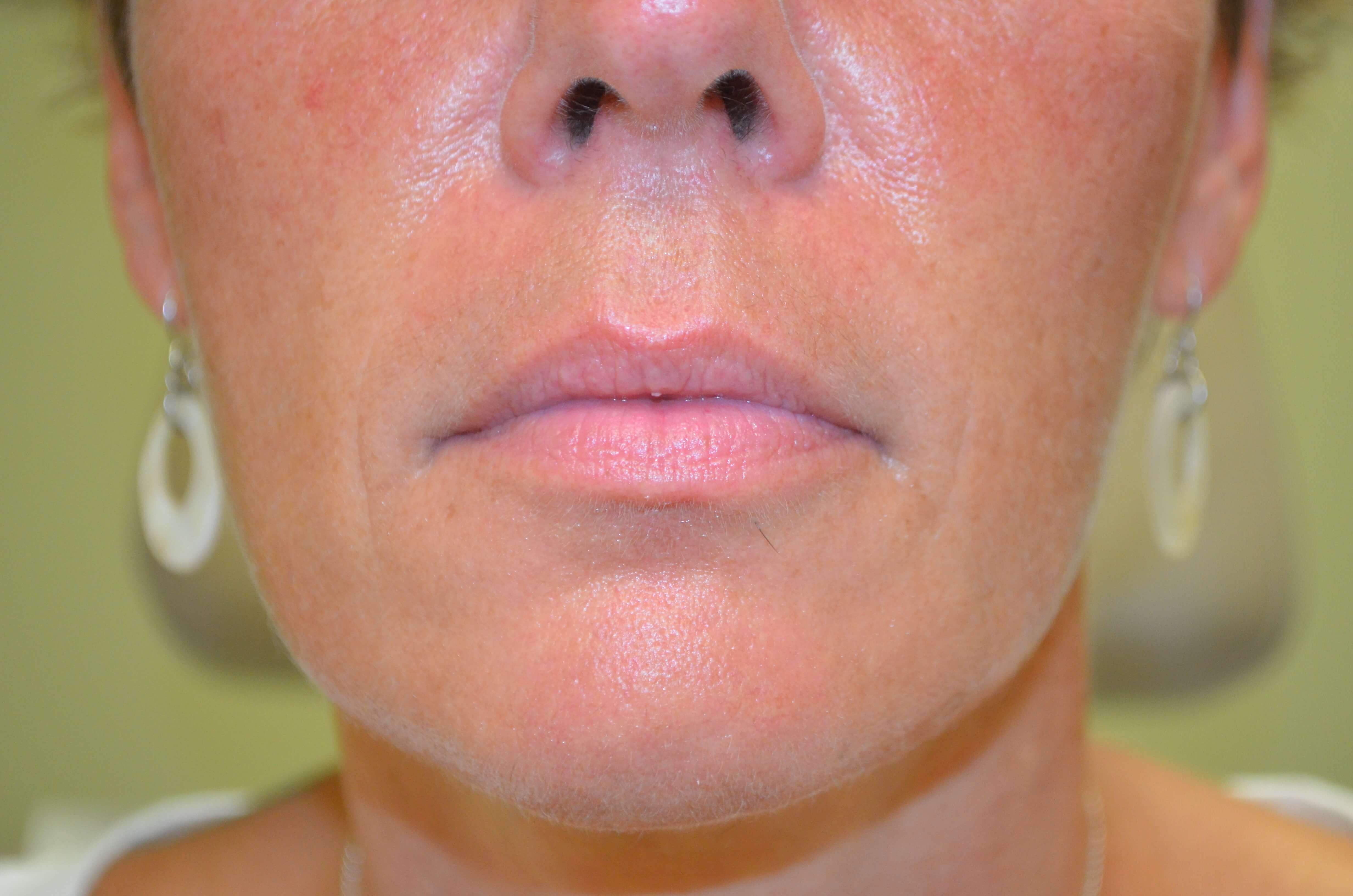 Lip Enhancement-Juvederm Before