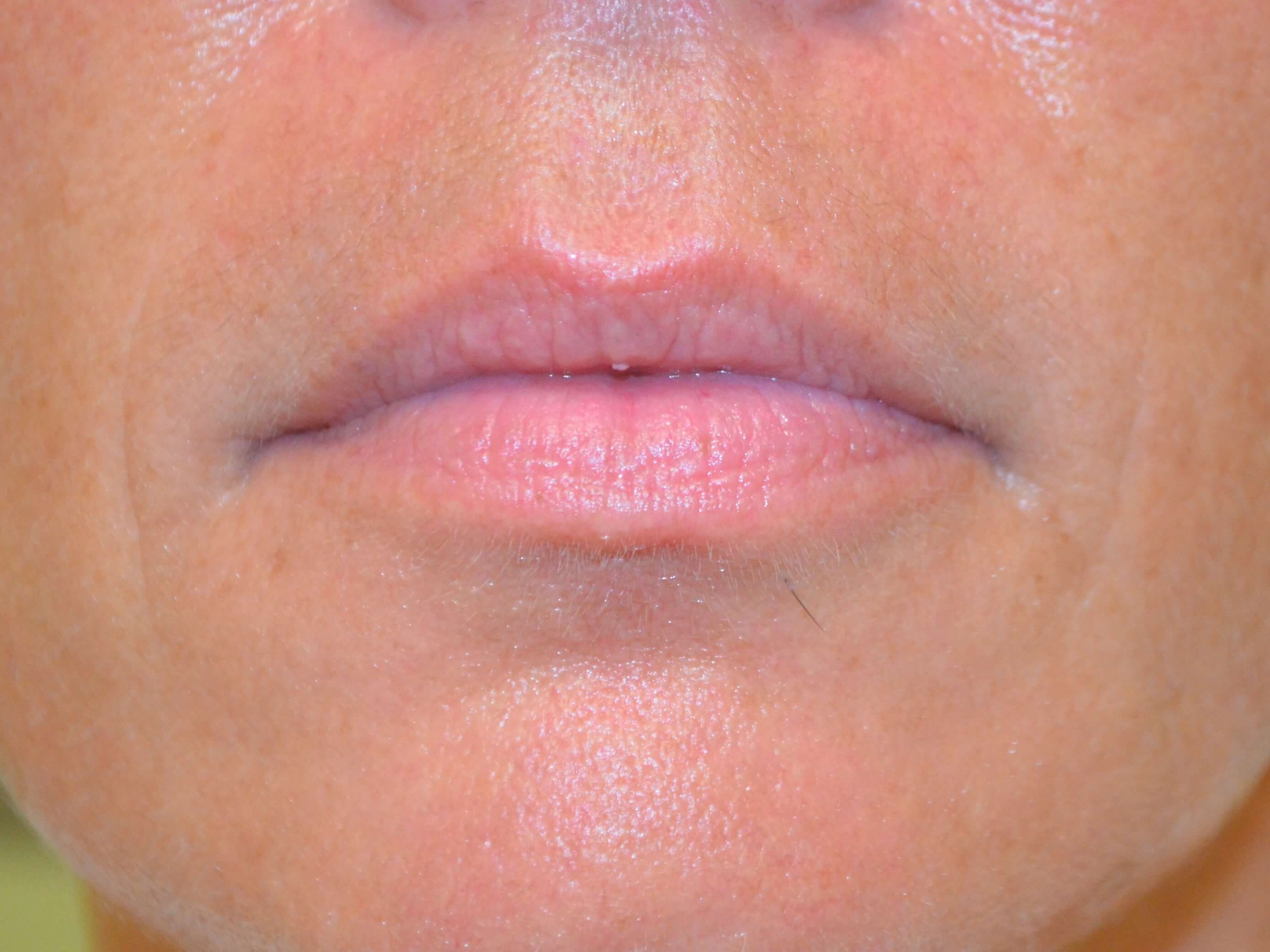 Lip Enhancement-Juvederm Before
