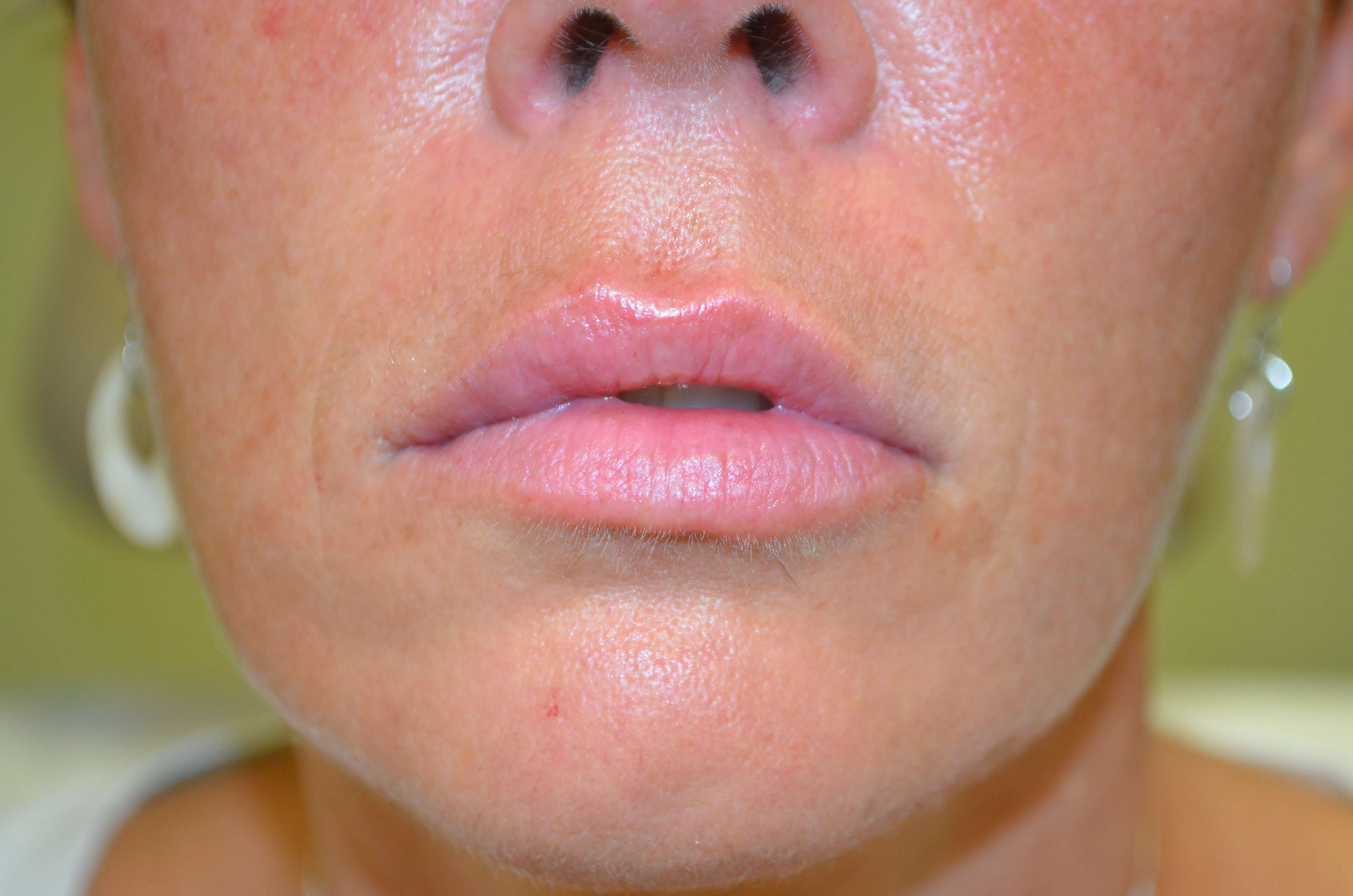 Lip Enhancement-Juvederm After