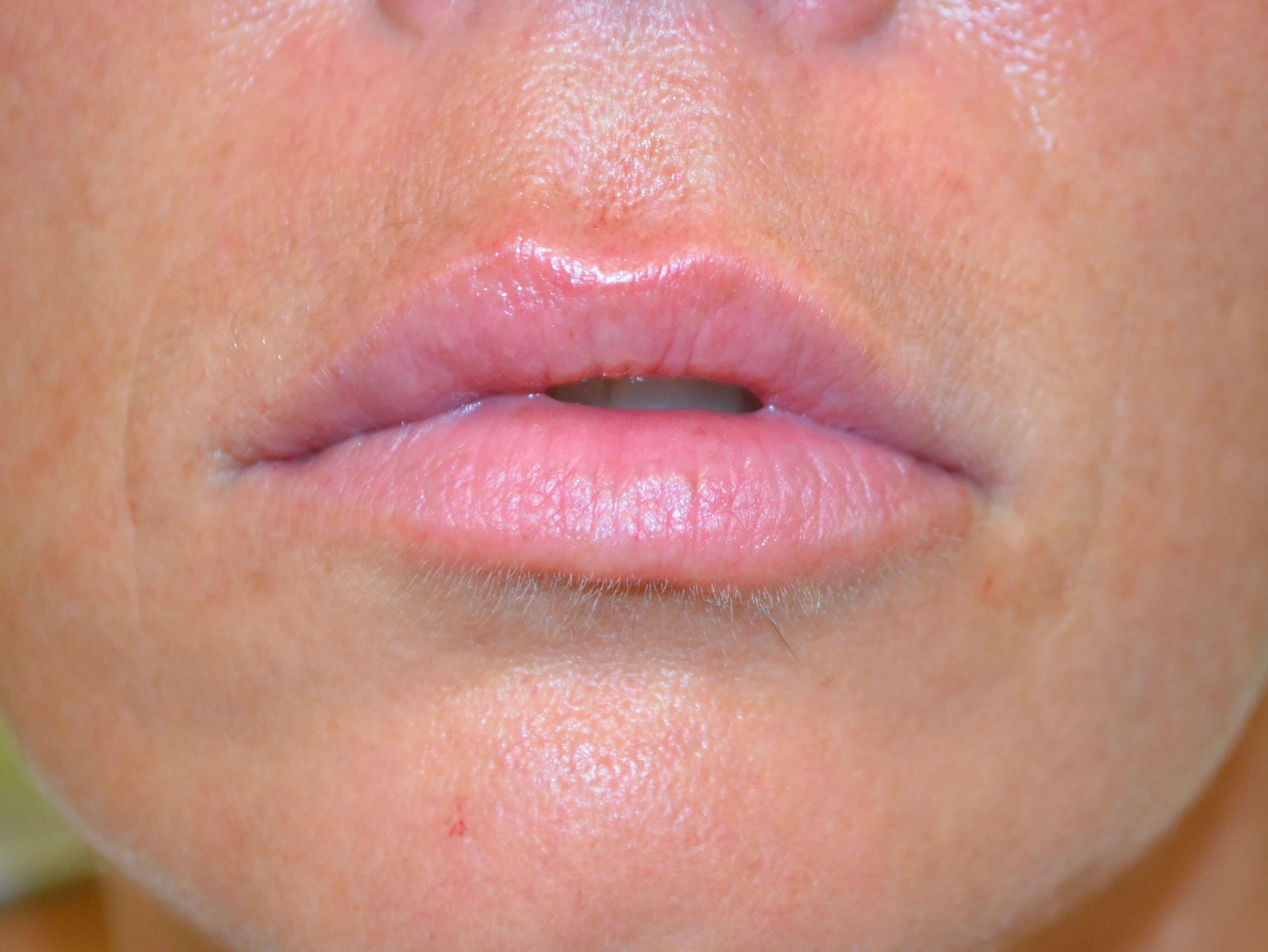 Lip Enhancement-Juvederm After