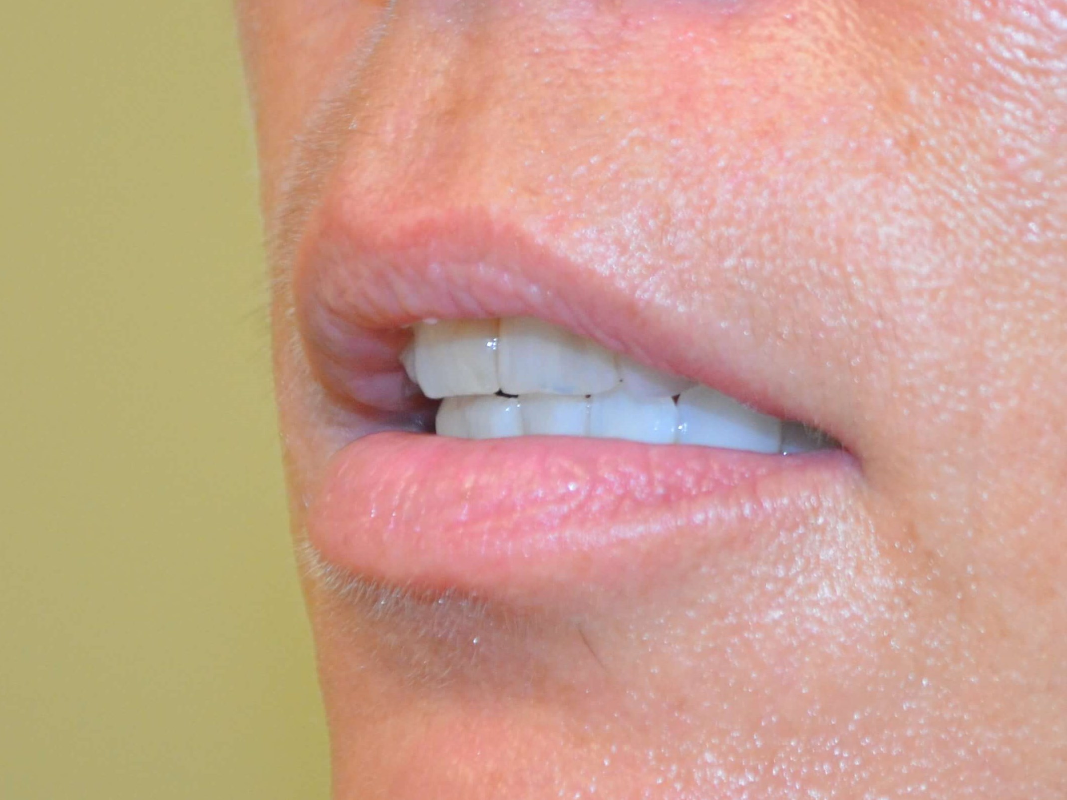 Lip Enhancement-Juvederm Before