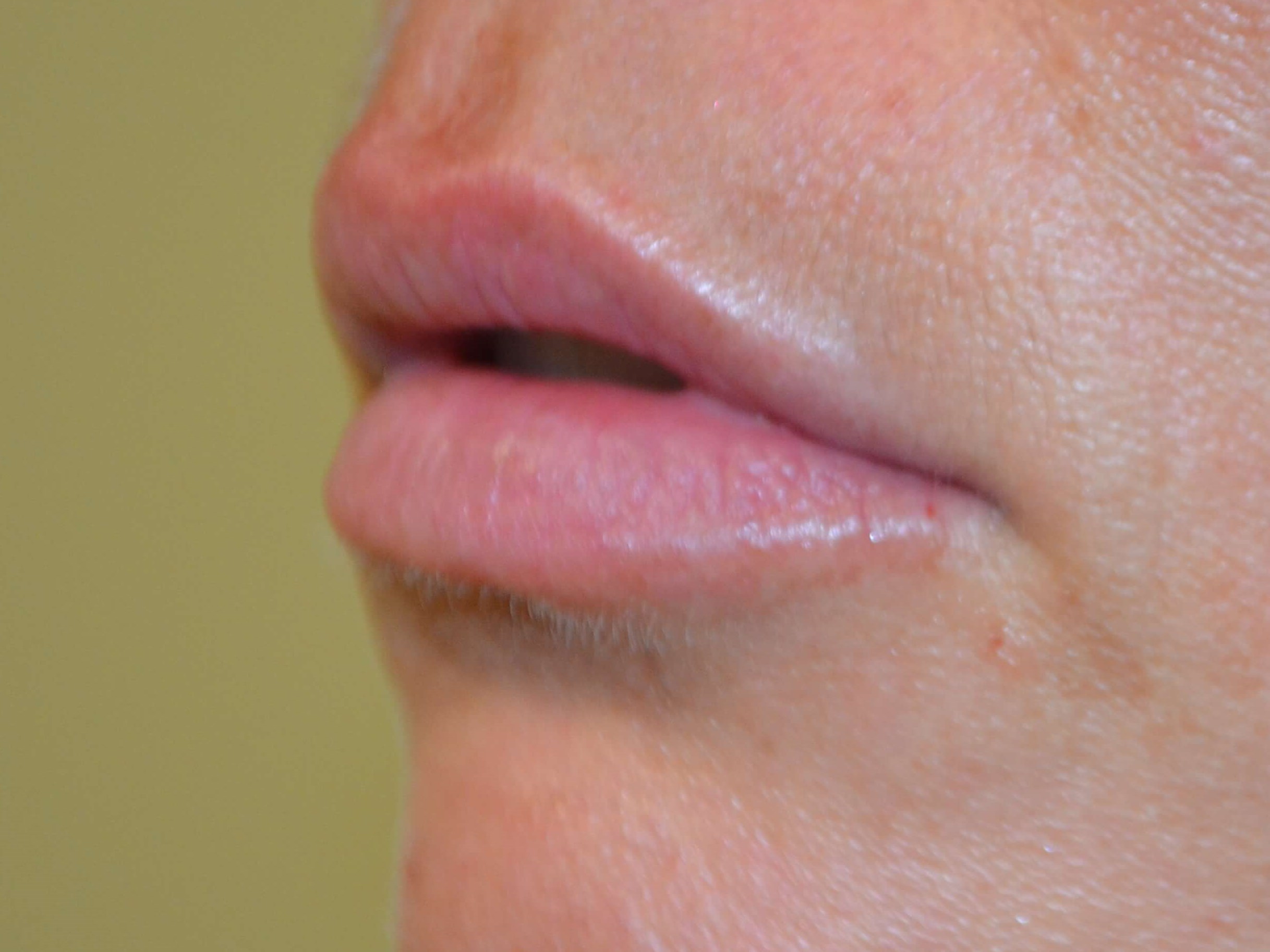 Lip Enhancement-Juvederm After