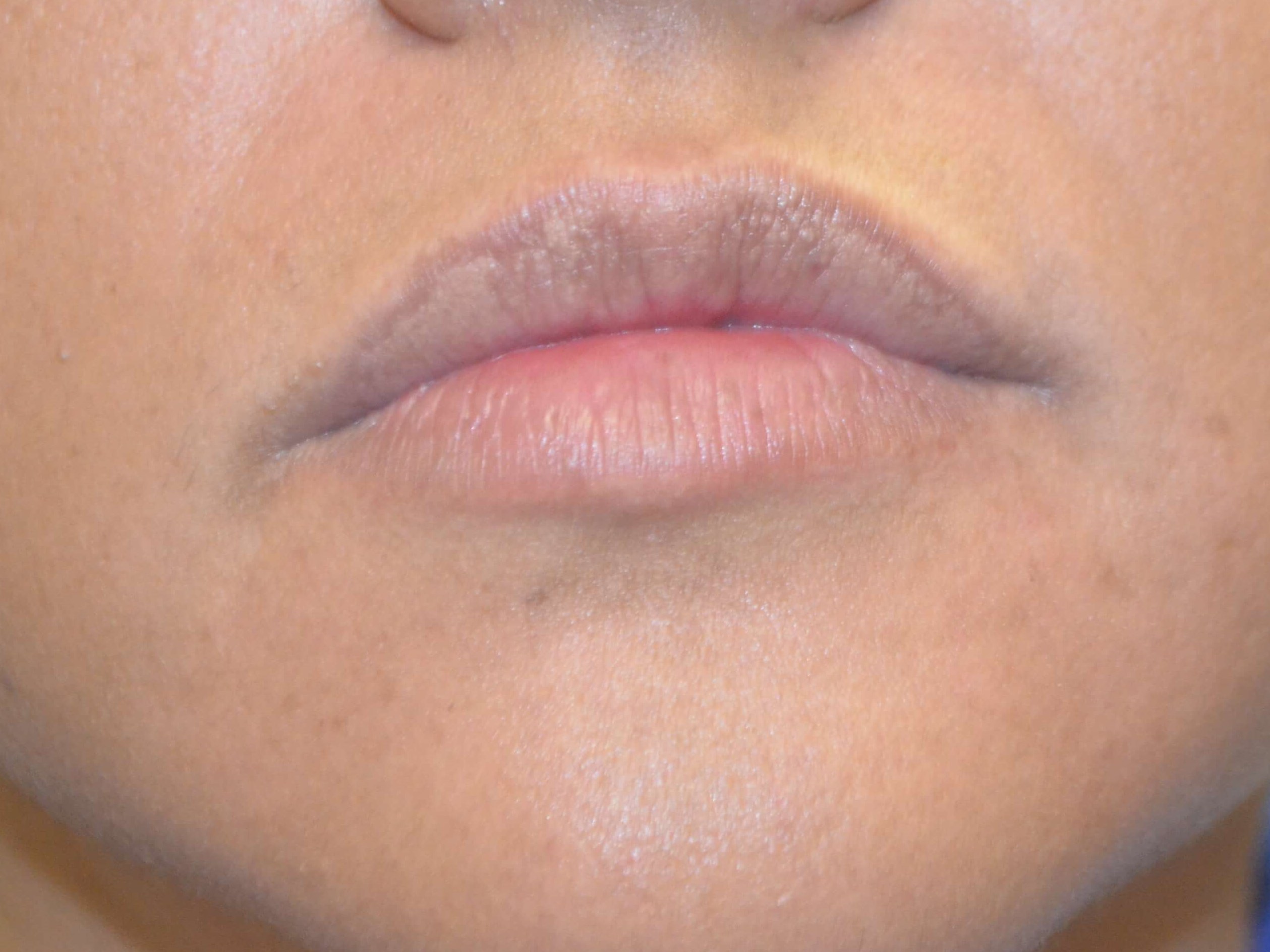 Lip Enhancement-Juvederm Before