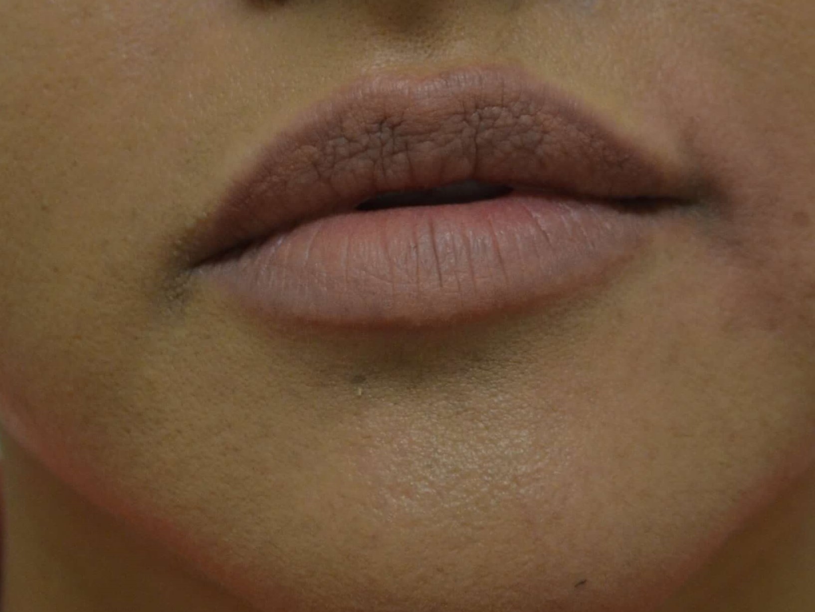 Lip Enhancement-Juvederm After