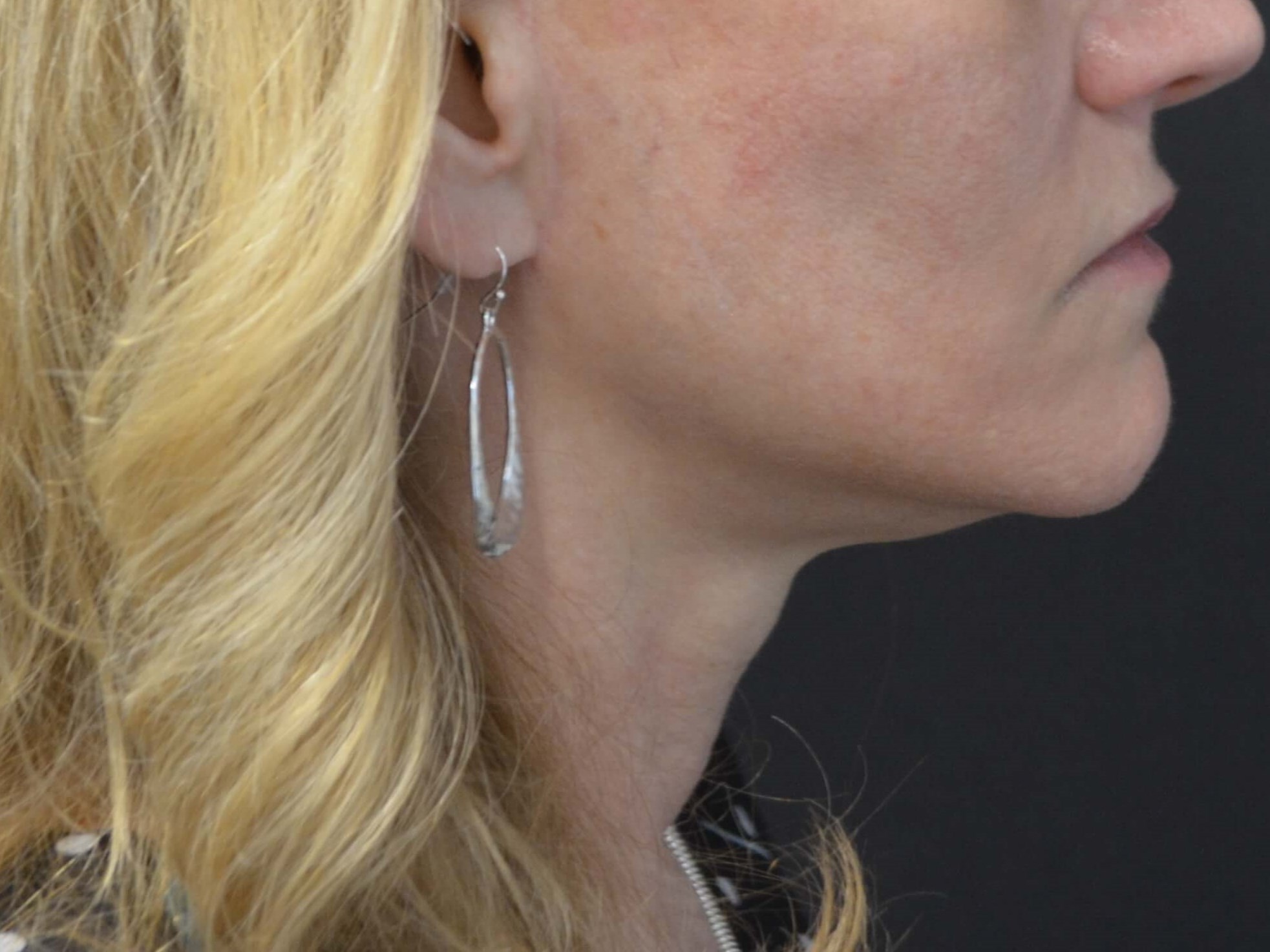 Lower Face & Neck Lift After
