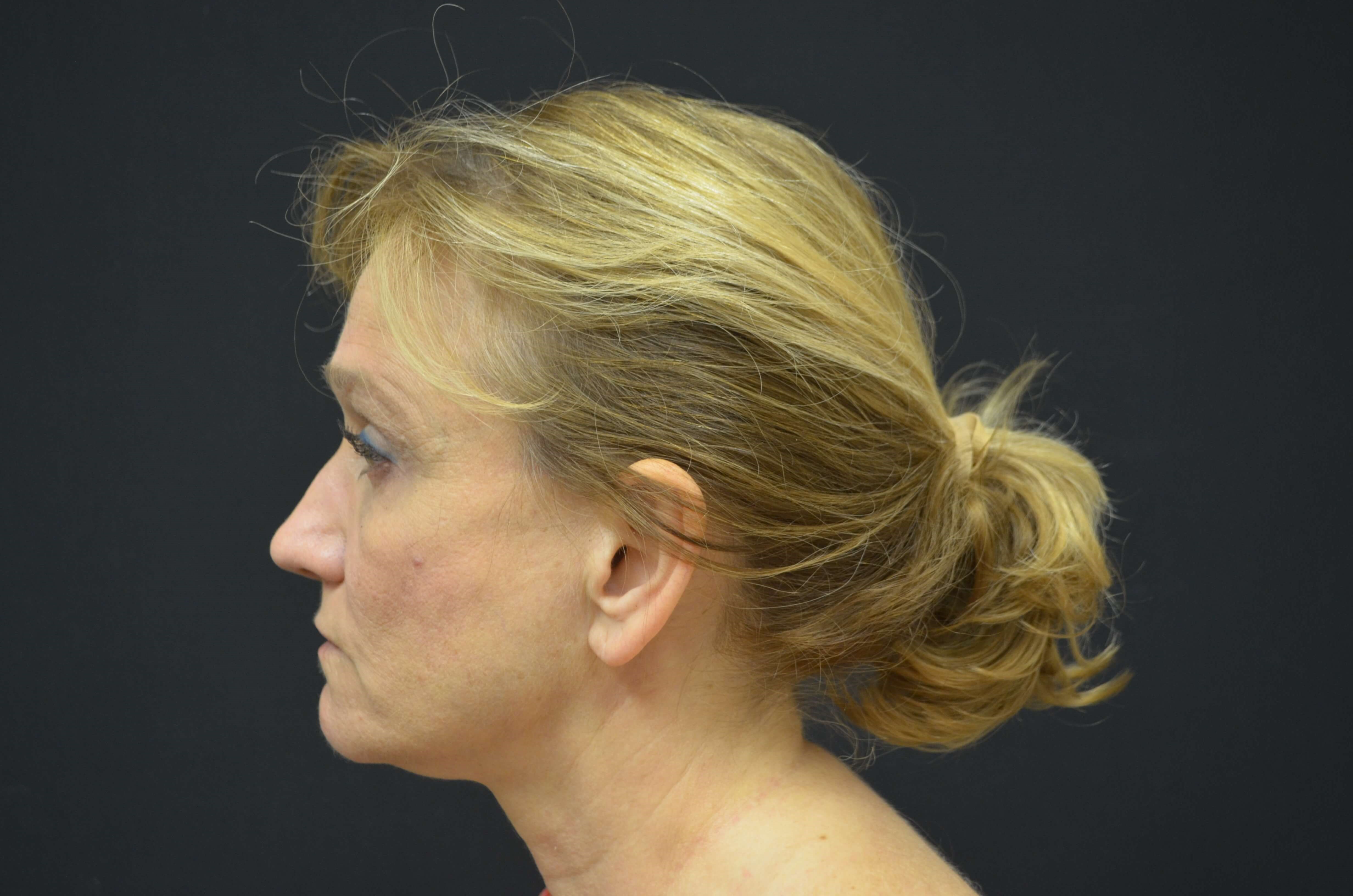 Lower Face & Neck Lift Before