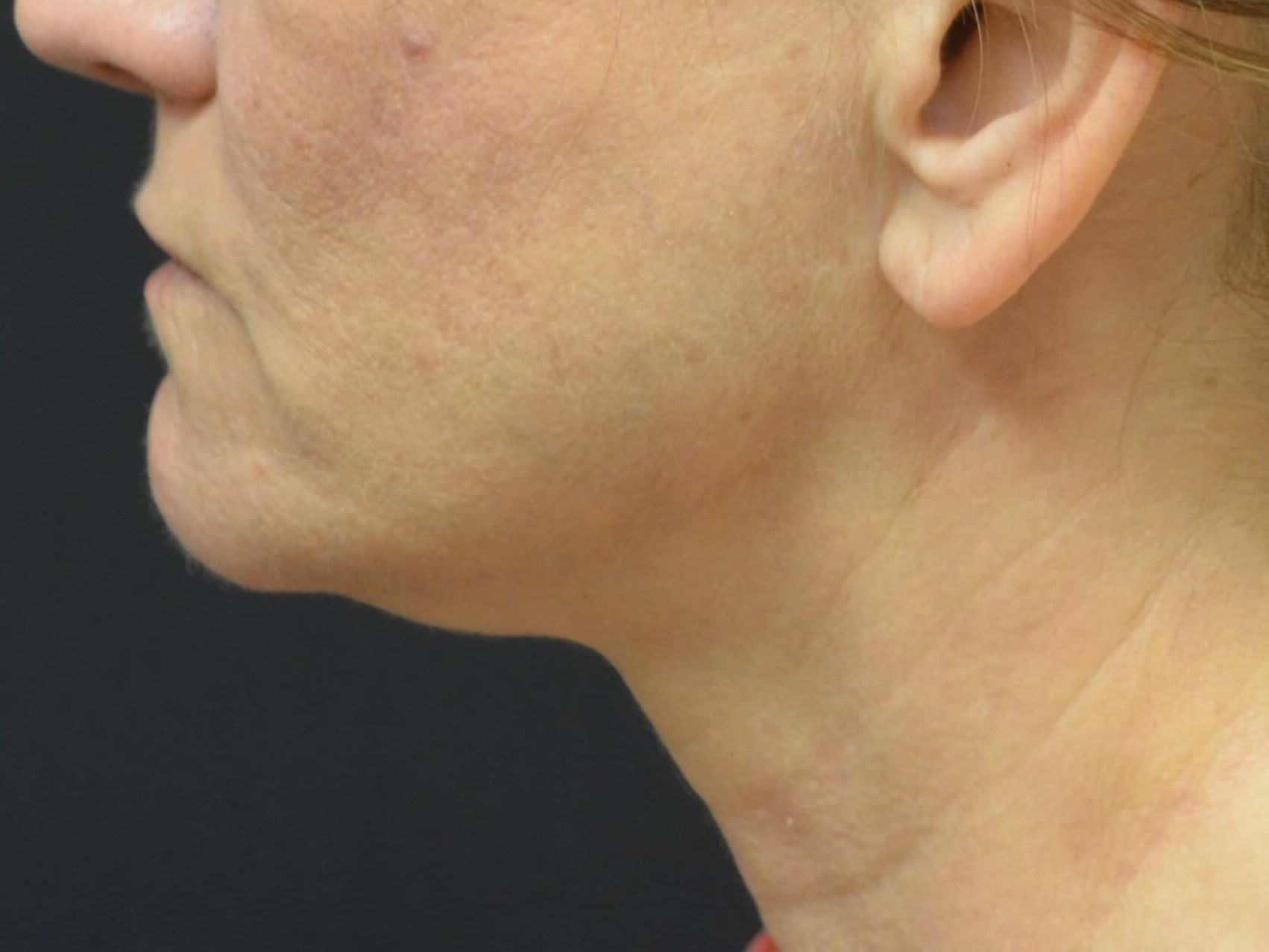 Lower Face & Neck Lift Before