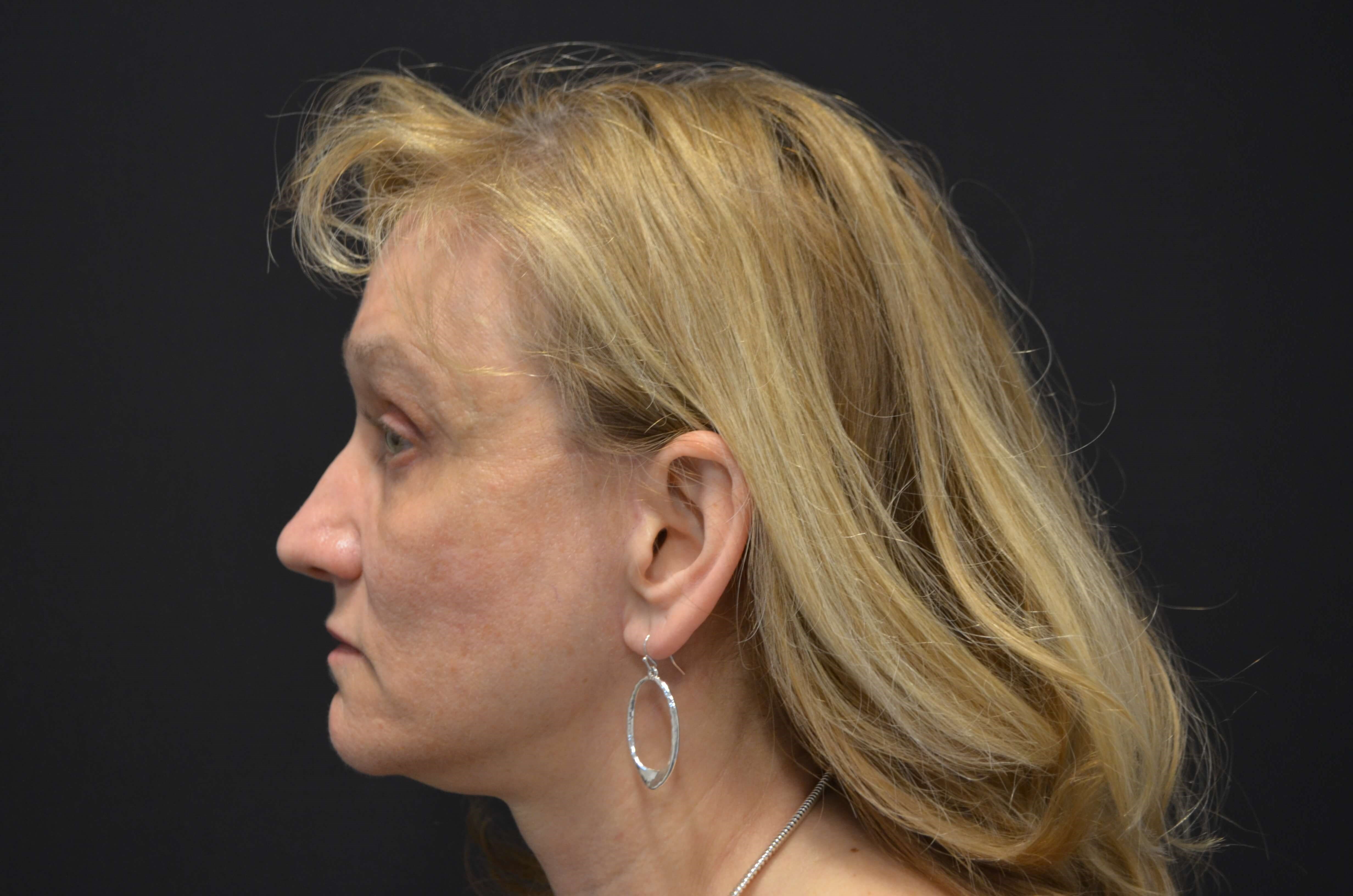 Lower Face & Neck Lift After