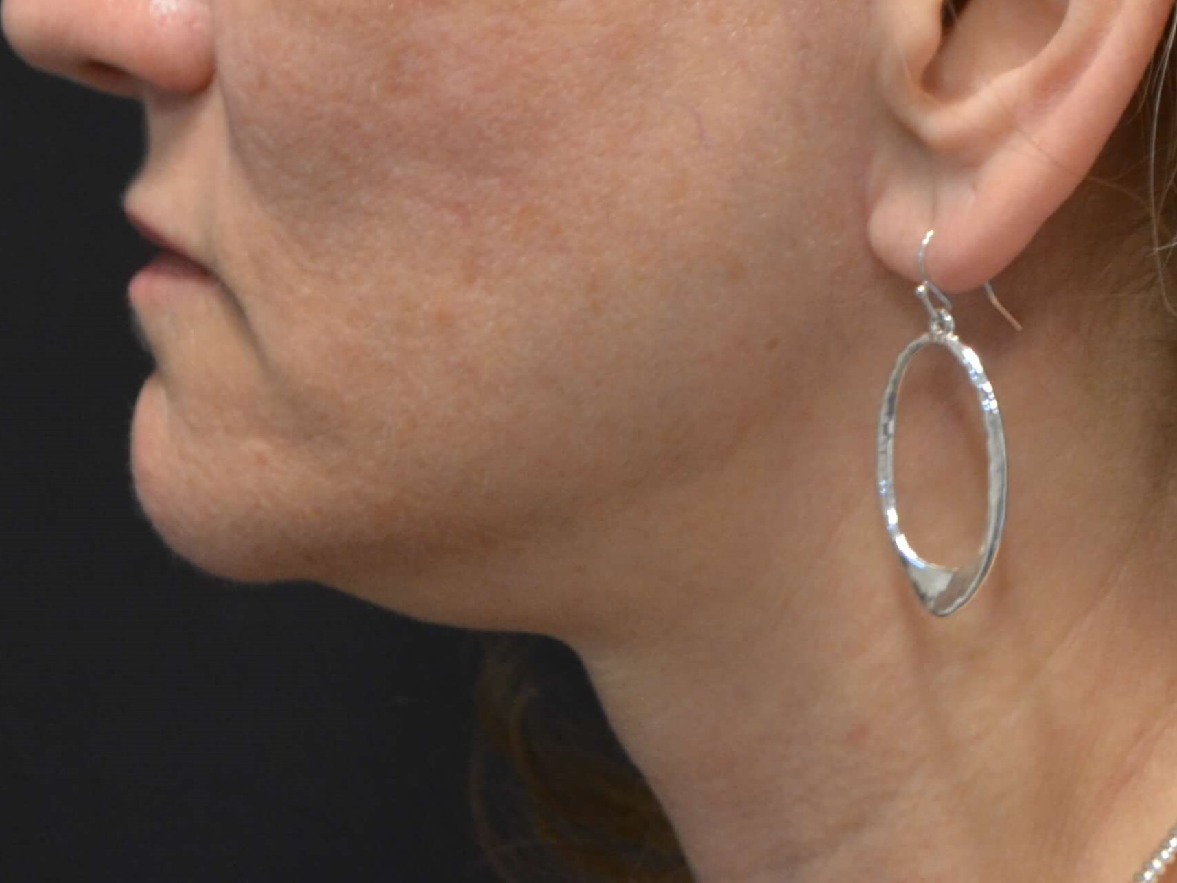Lower Face & Neck Lift After
