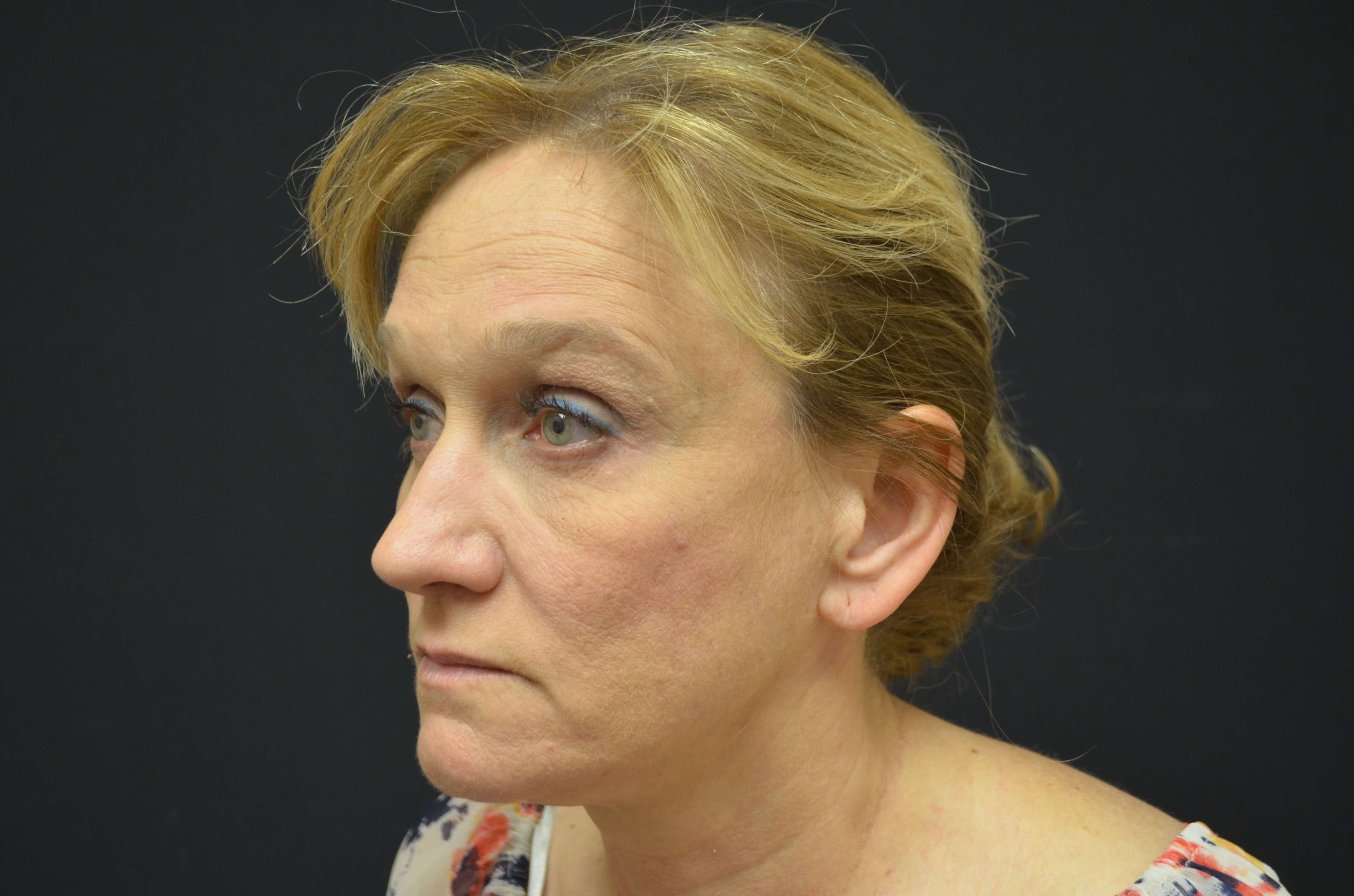Lower Face & Neck Lift Before