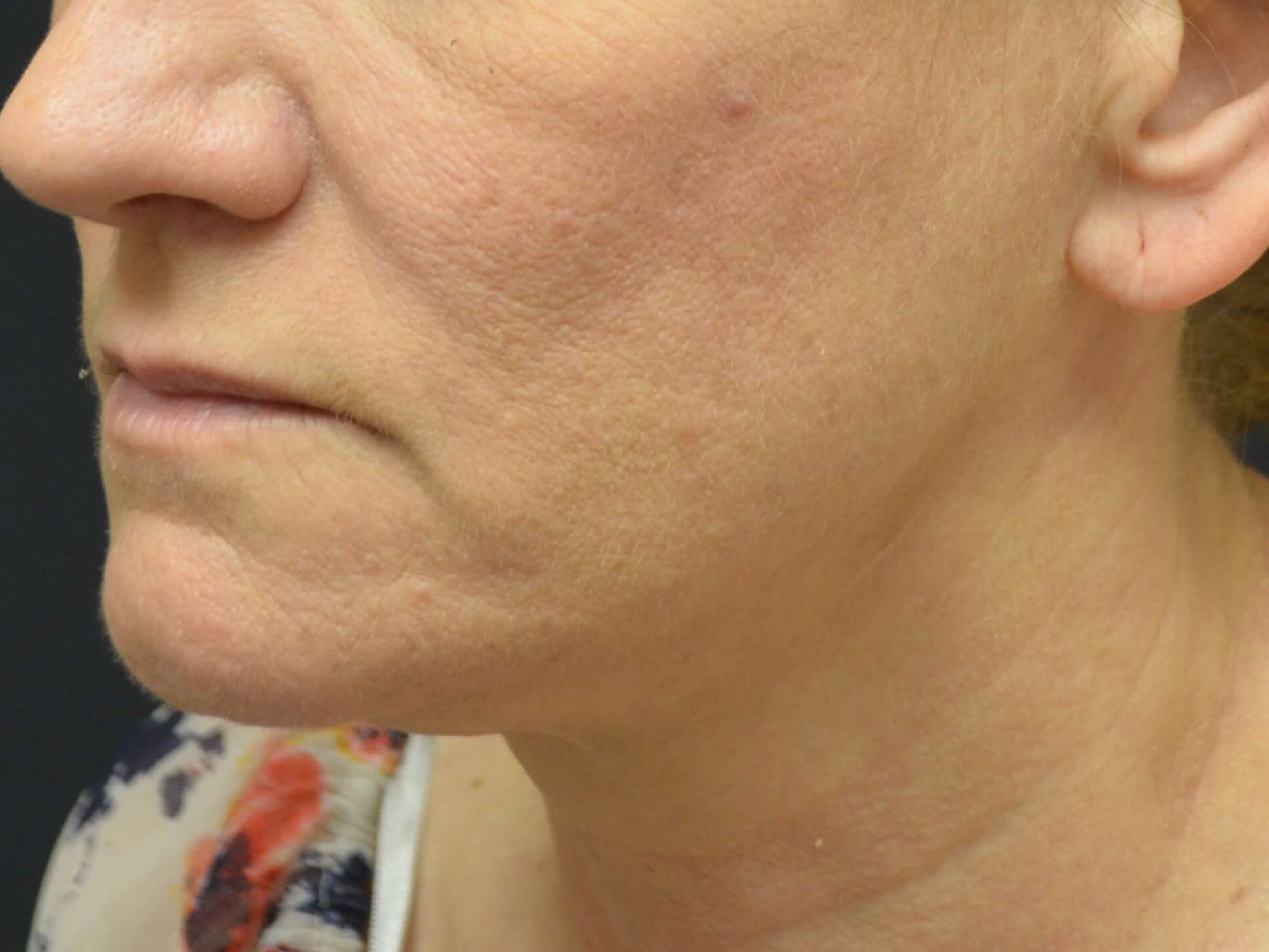 Lower Face & Neck Lift Before
