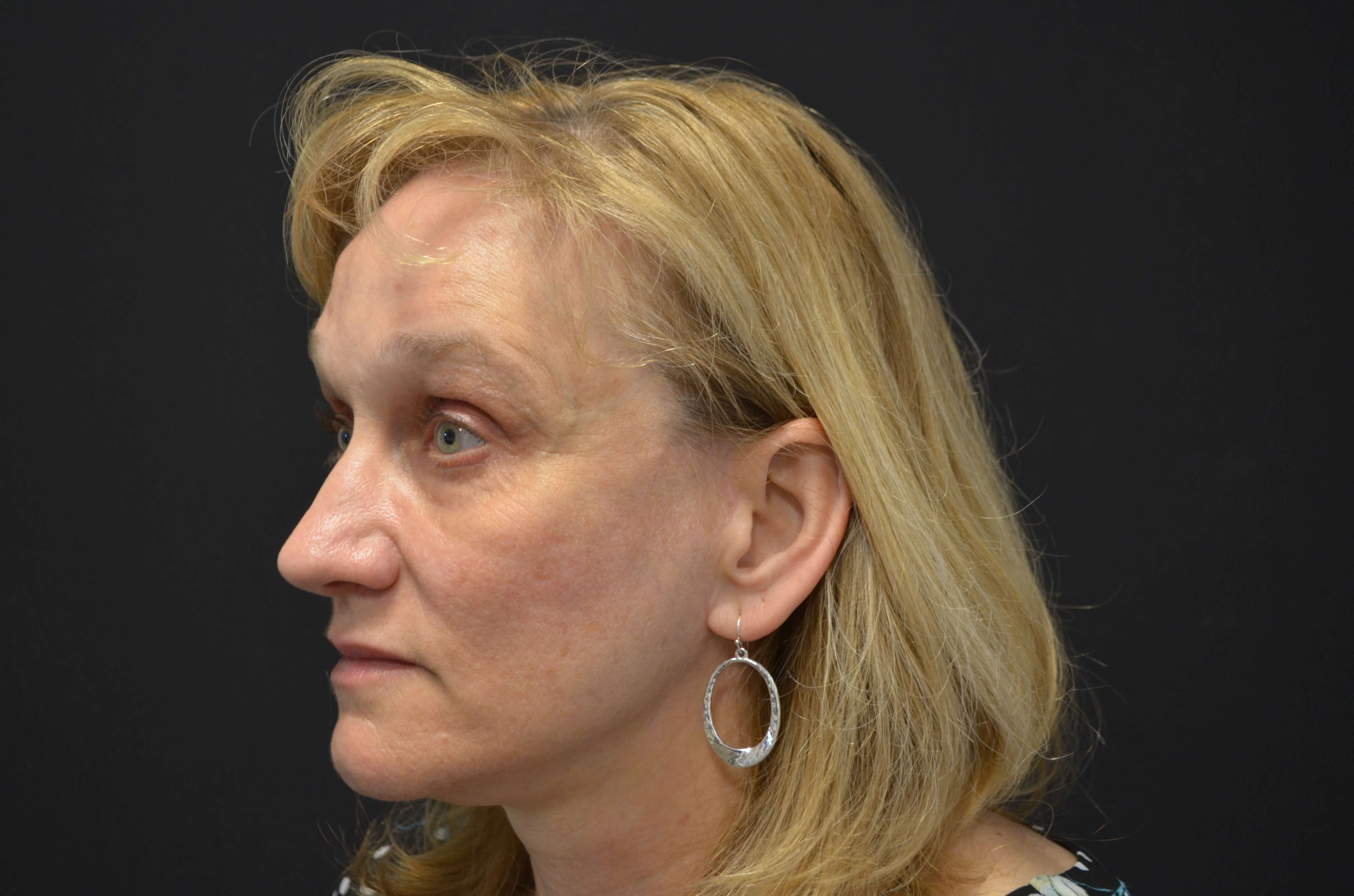 Lower Face & Neck Lift After