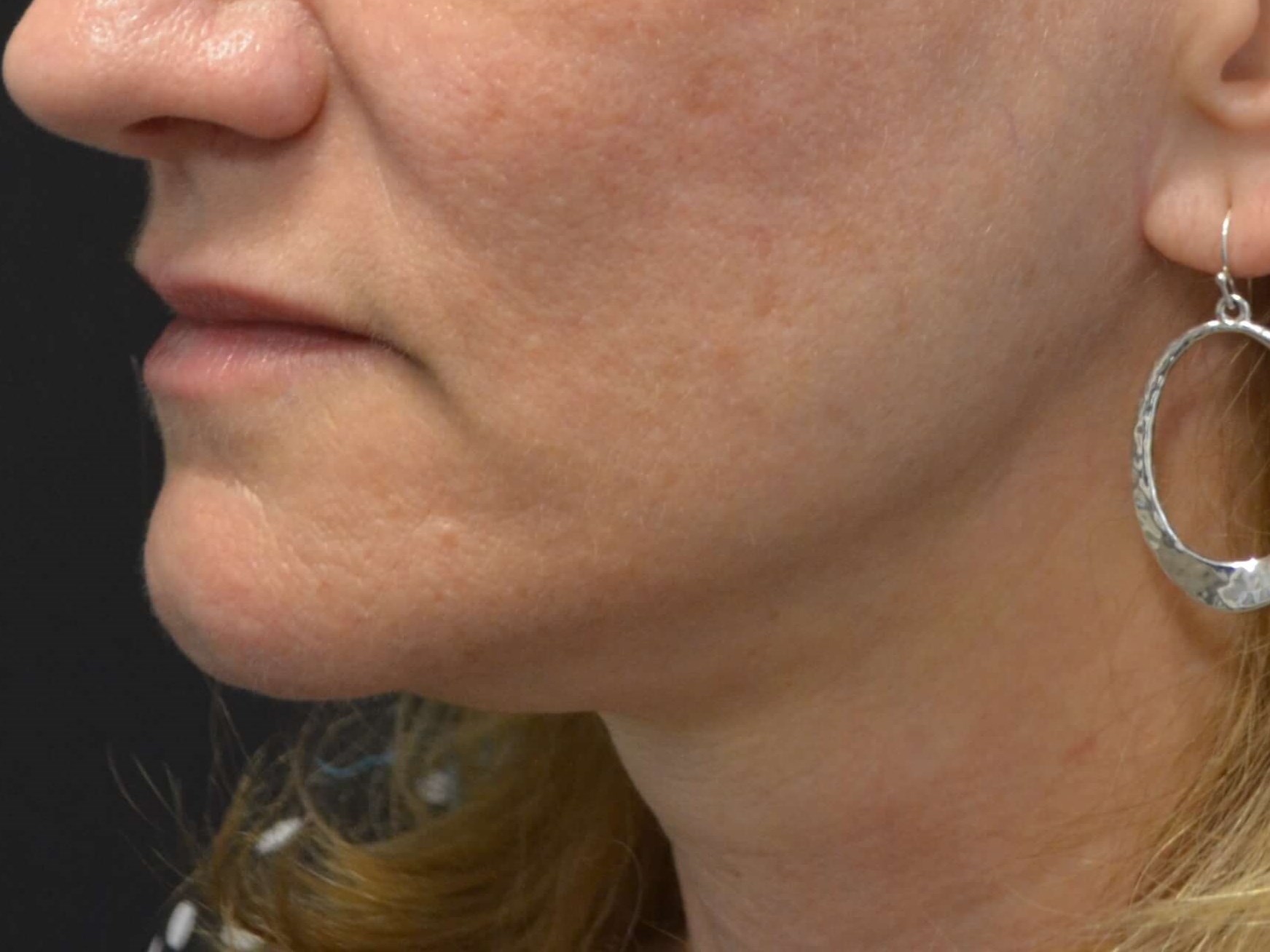 Lower Face & Neck Lift After