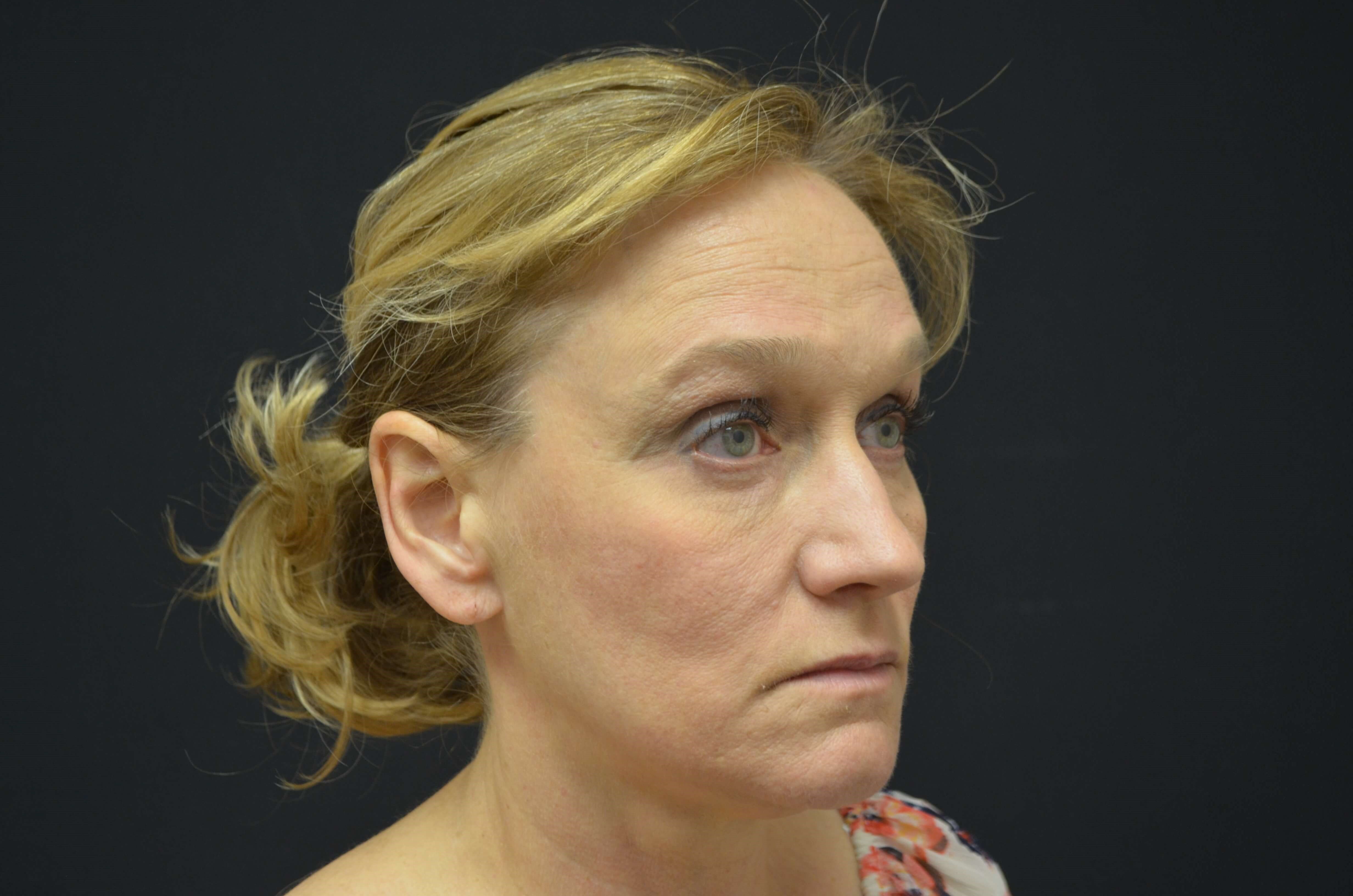 Lower Face & Neck Lift Before