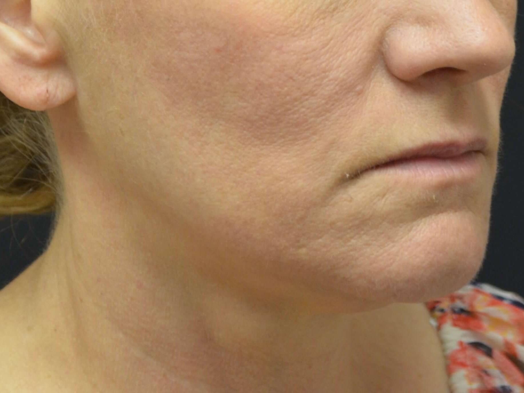 Lower Face & Neck Lift Before
