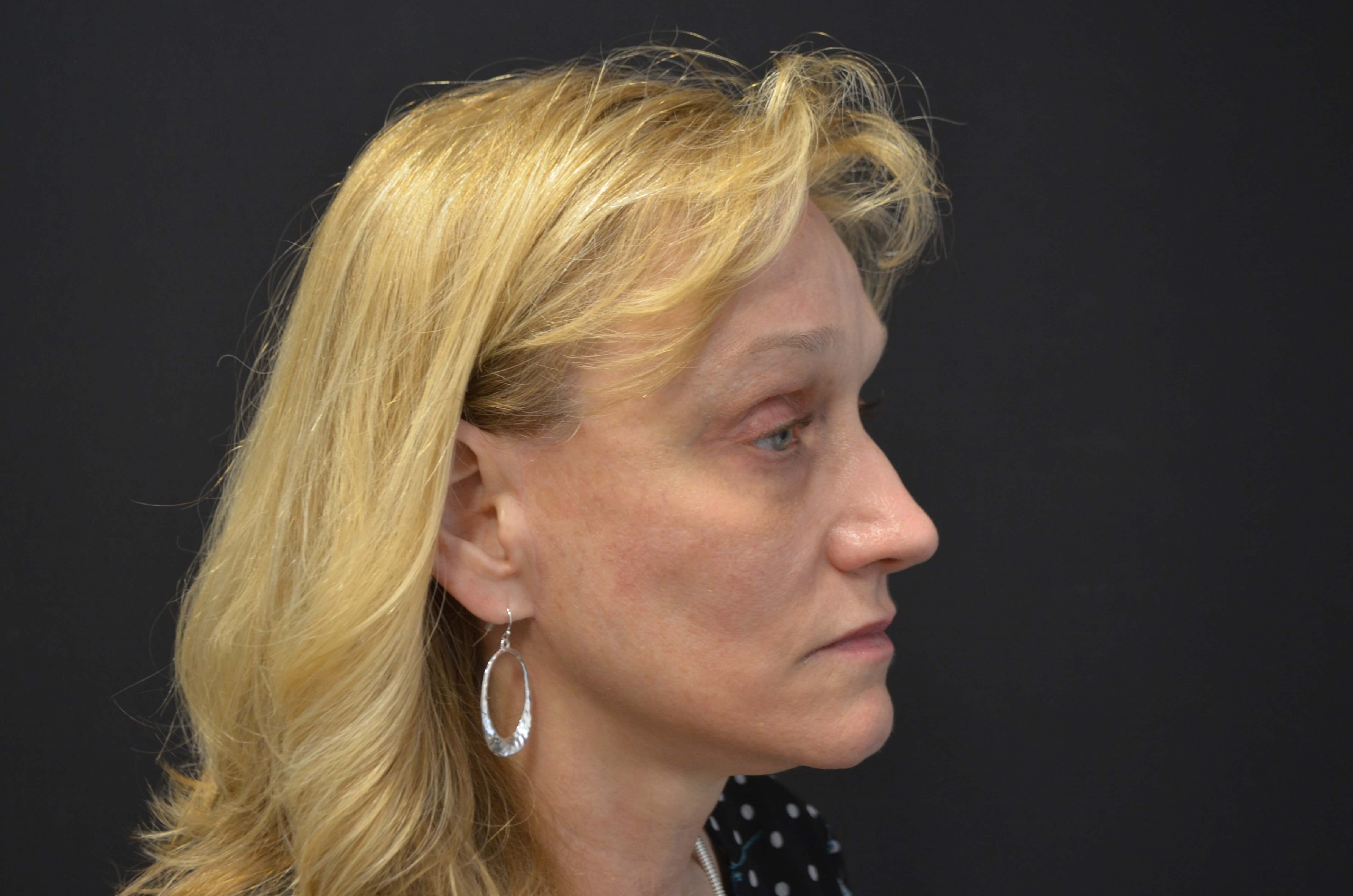 Lower Face & Neck Lift After