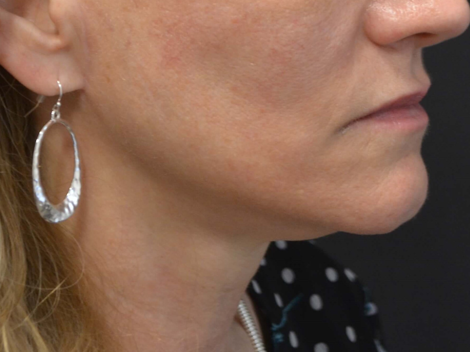 Lower Face & Neck Lift After