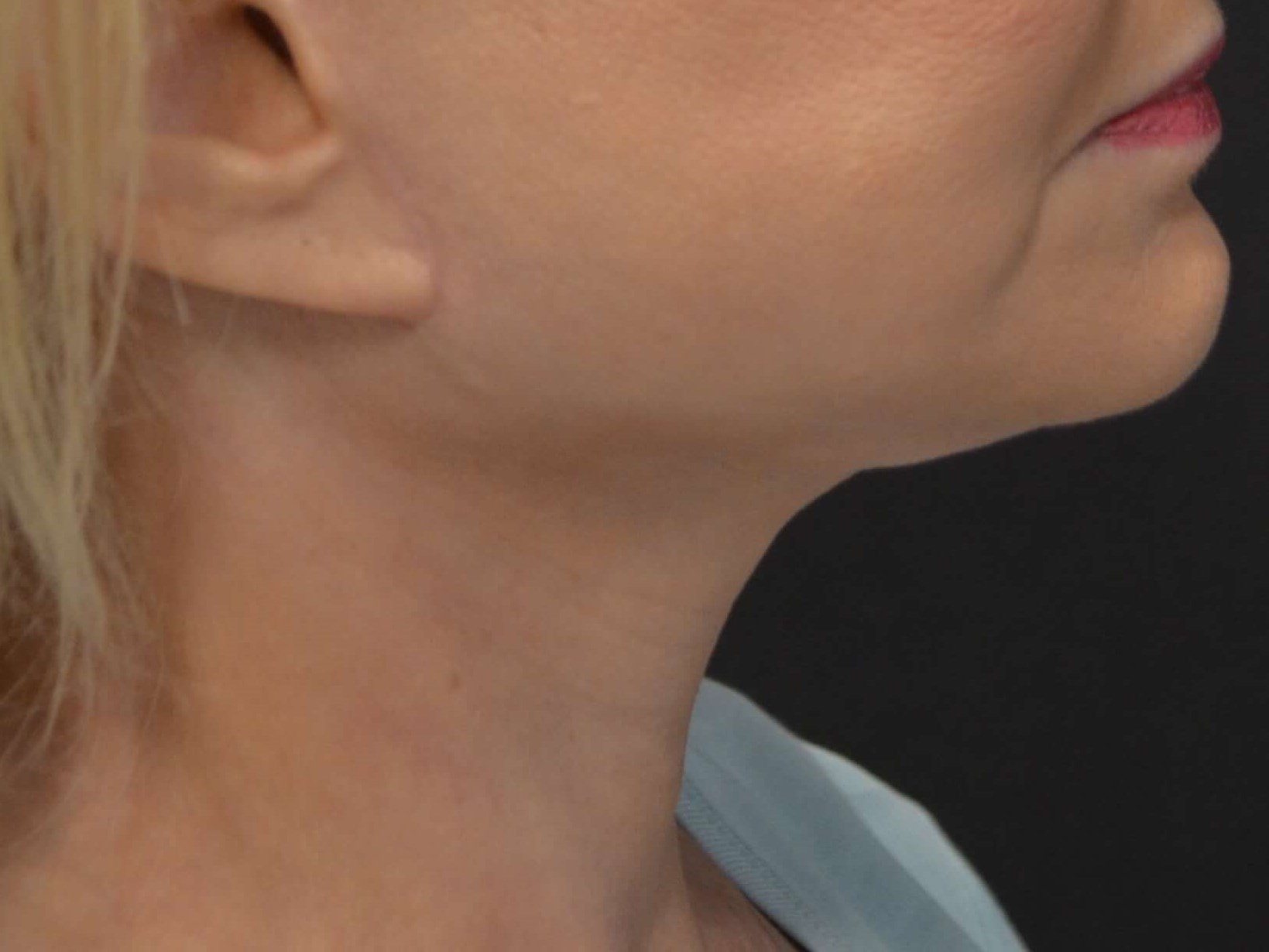 Lower Face & Neck Lift After