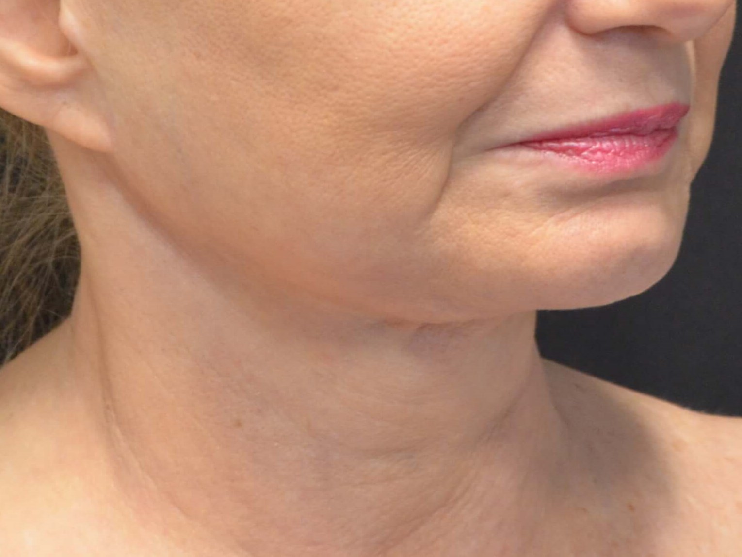 Lower Face & Neck Lift Before