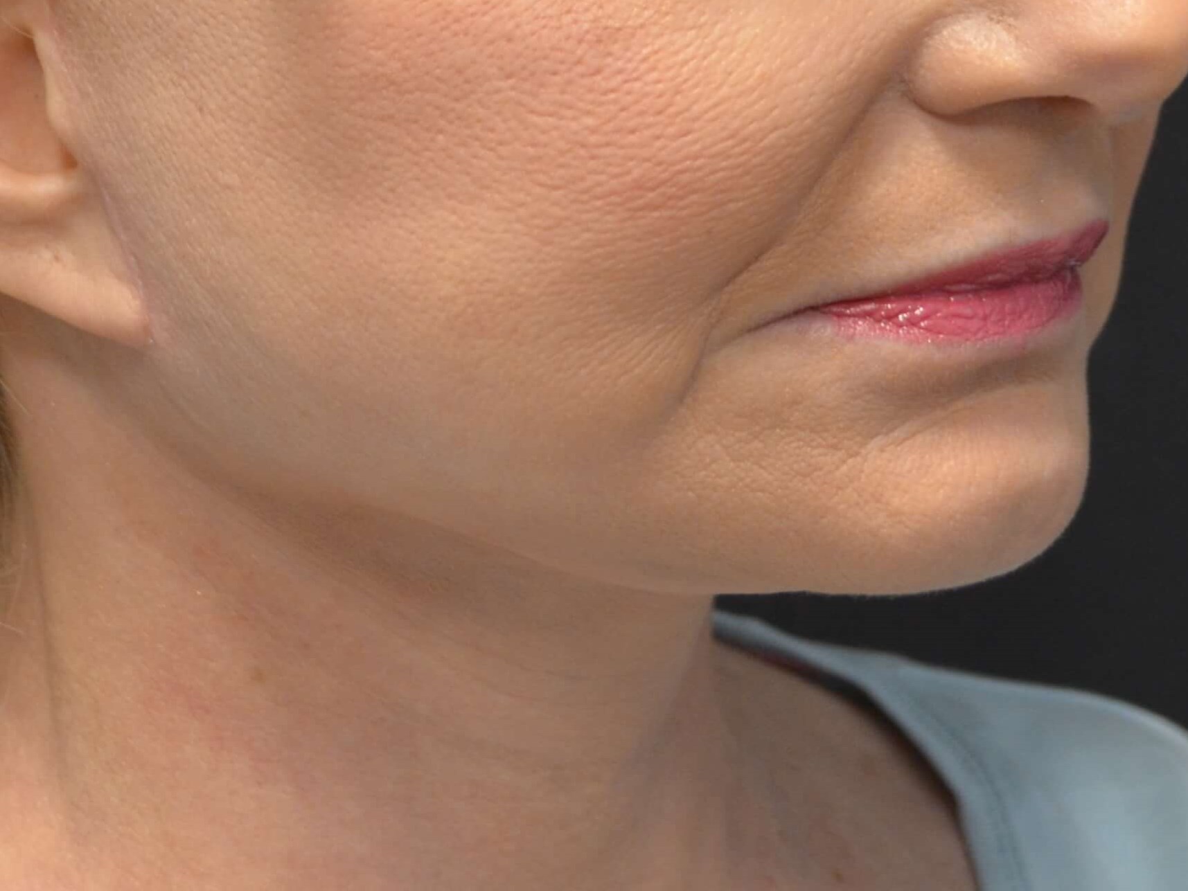 Lower Face & Neck Lift After