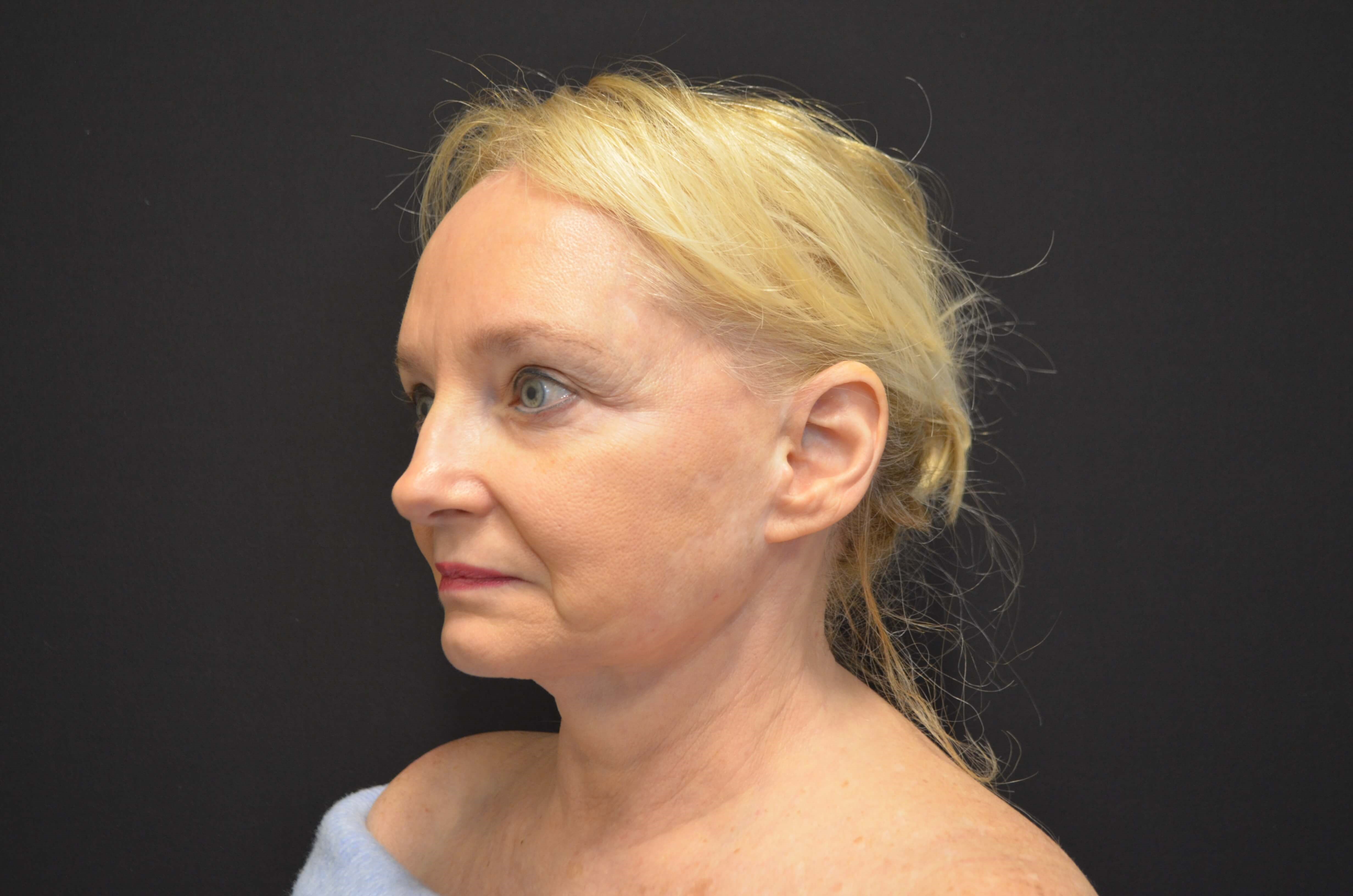 Lower Face & Neck Lift Before