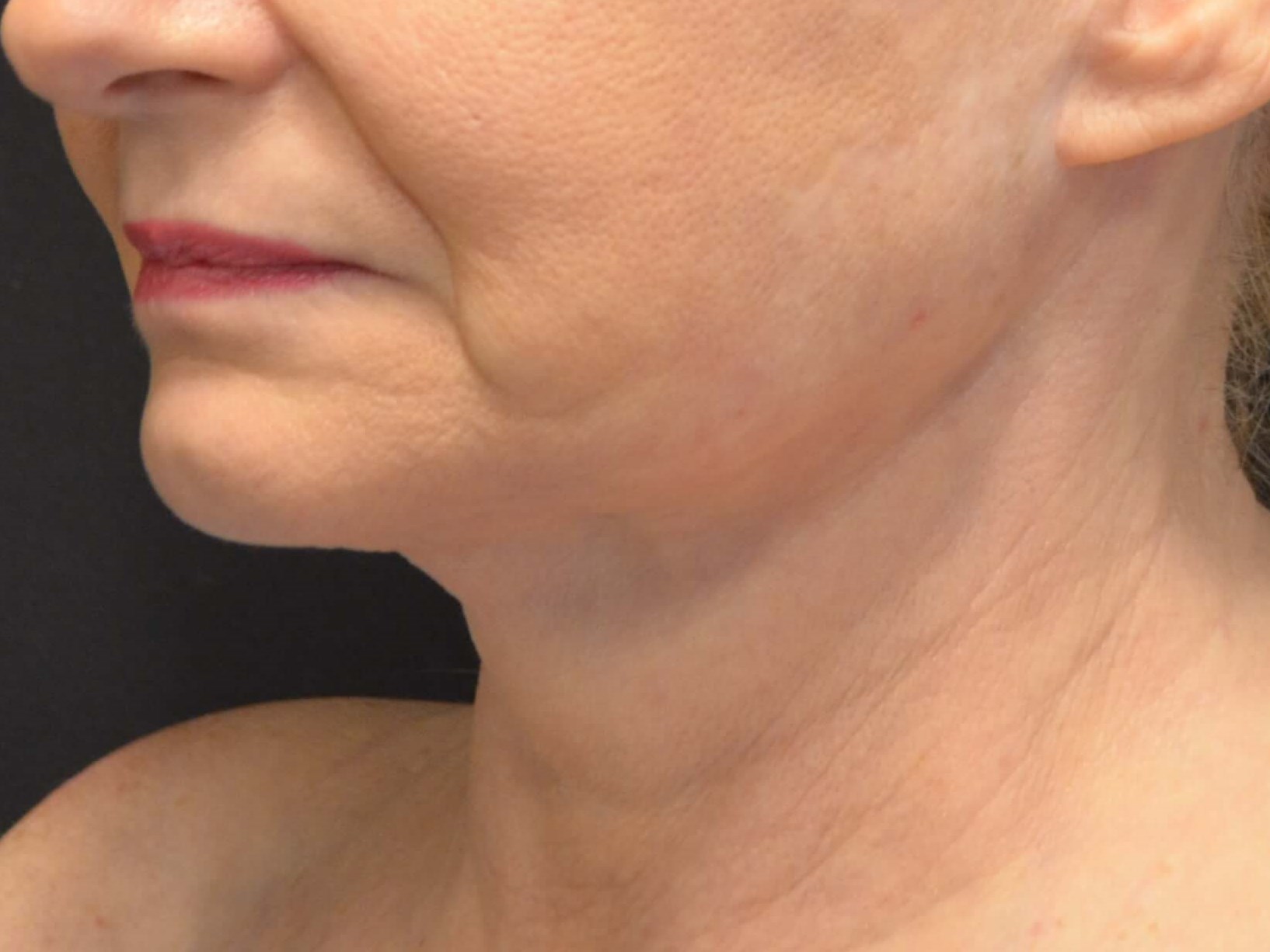 Lower Face & Neck Lift Before