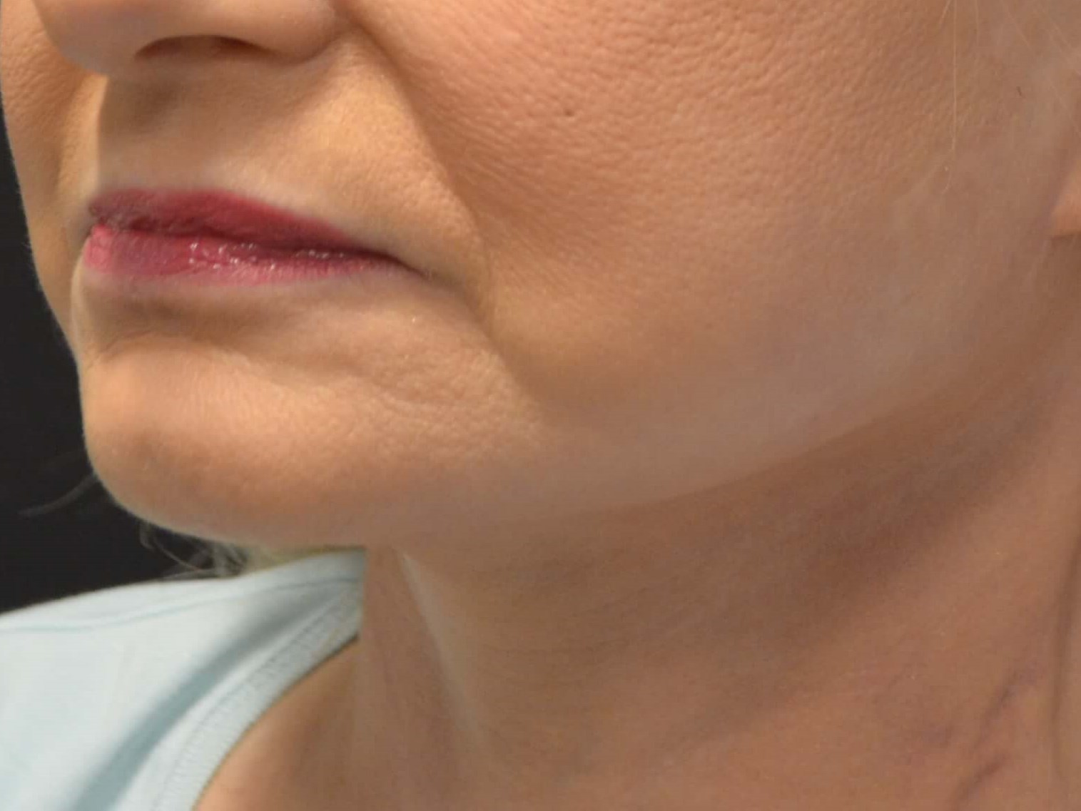 Lower Face & Neck Lift After