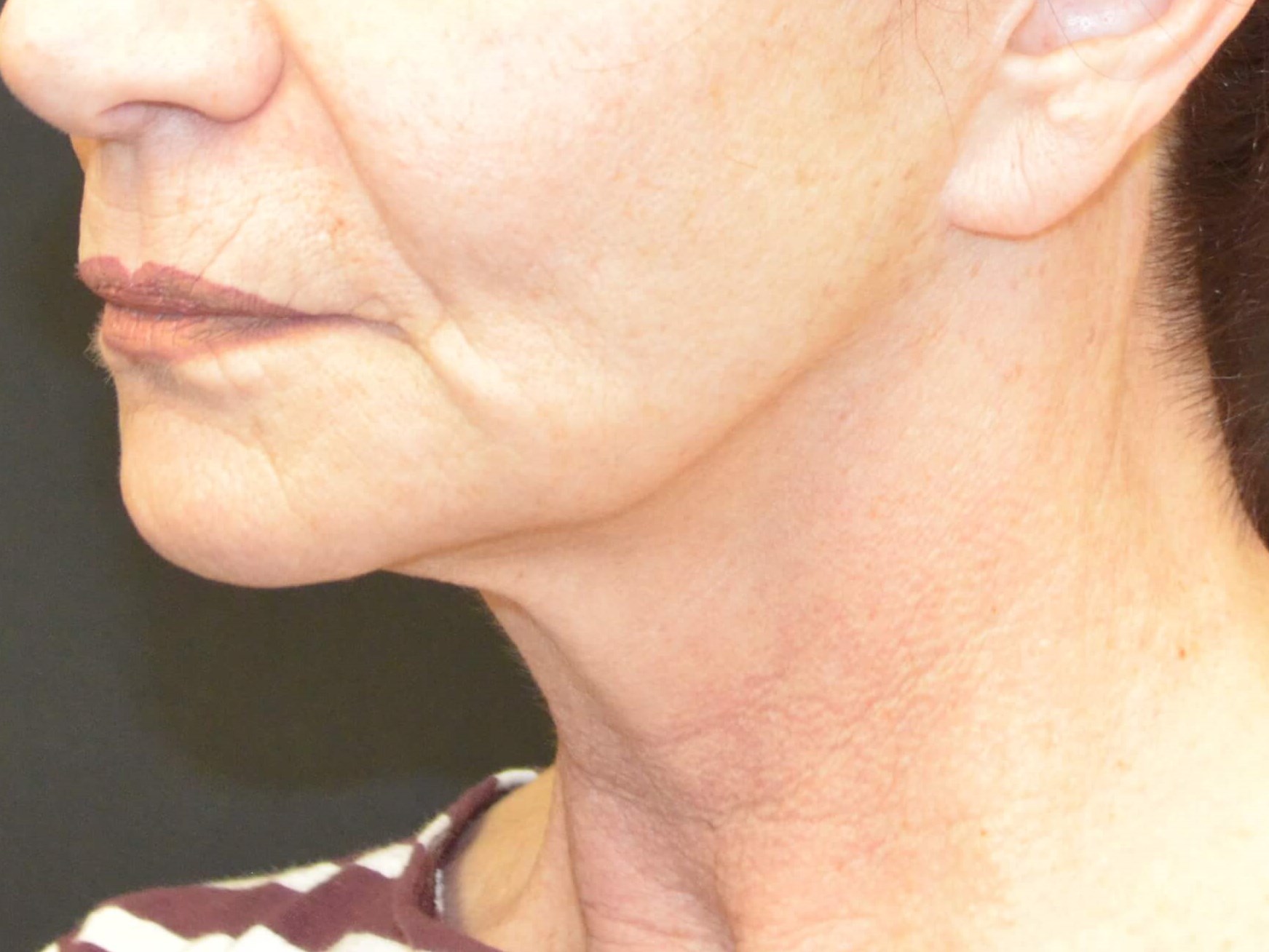 Lower Face & Neck Lift Before