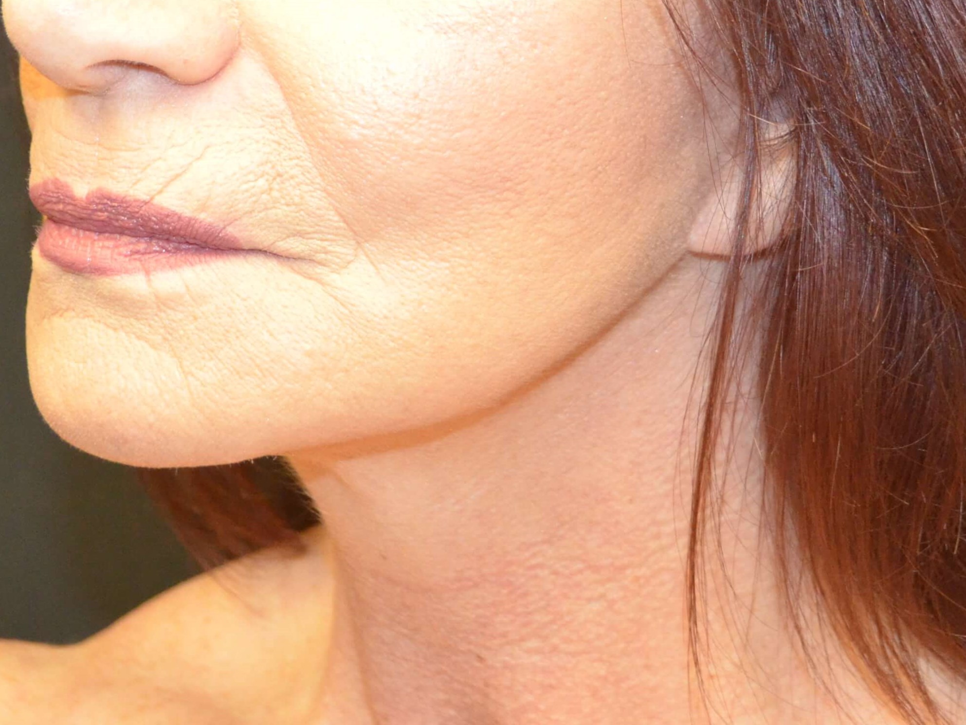 Lower Face & Neck Lift After