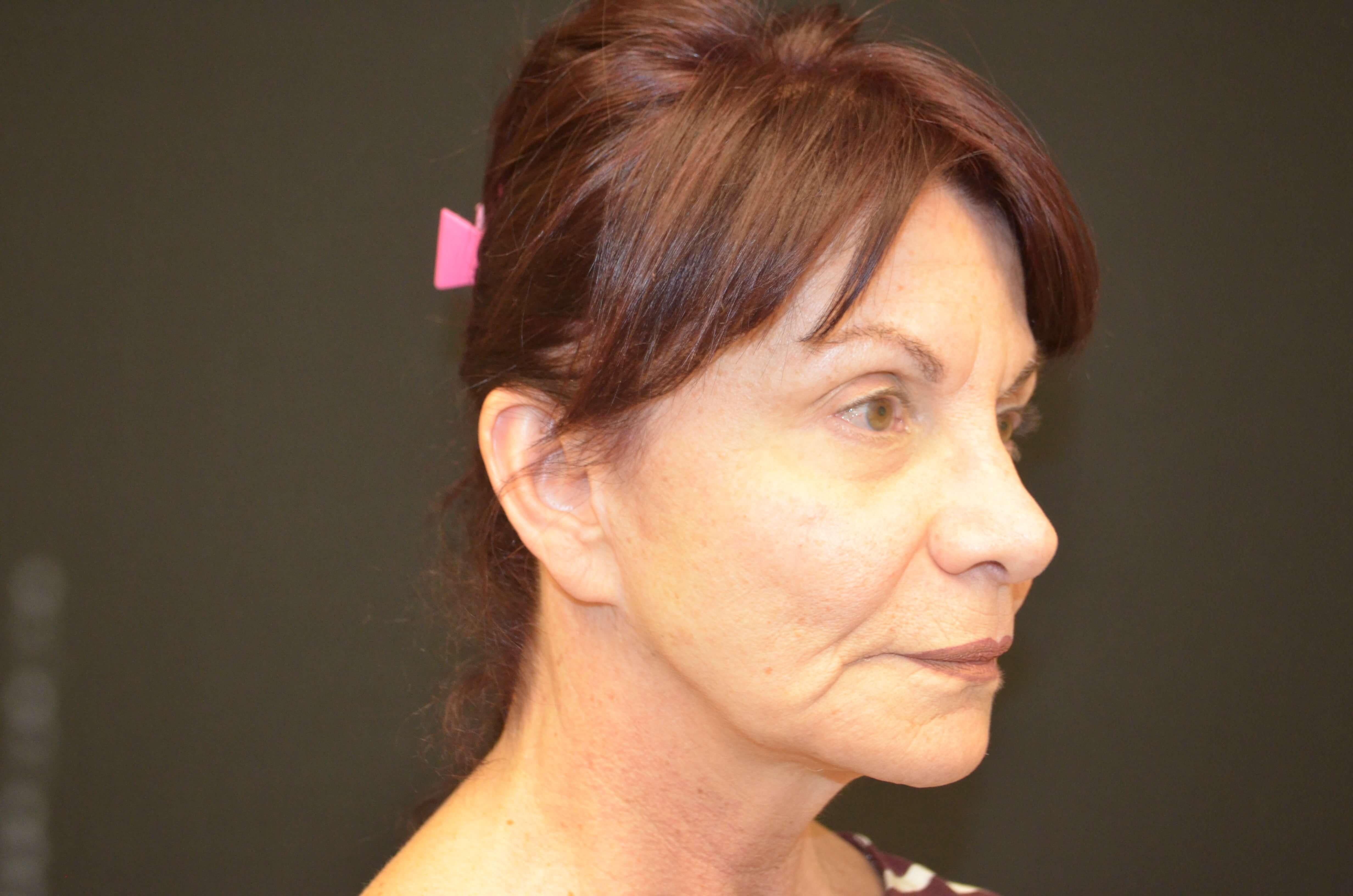 Lower Face & Neck Lift Before