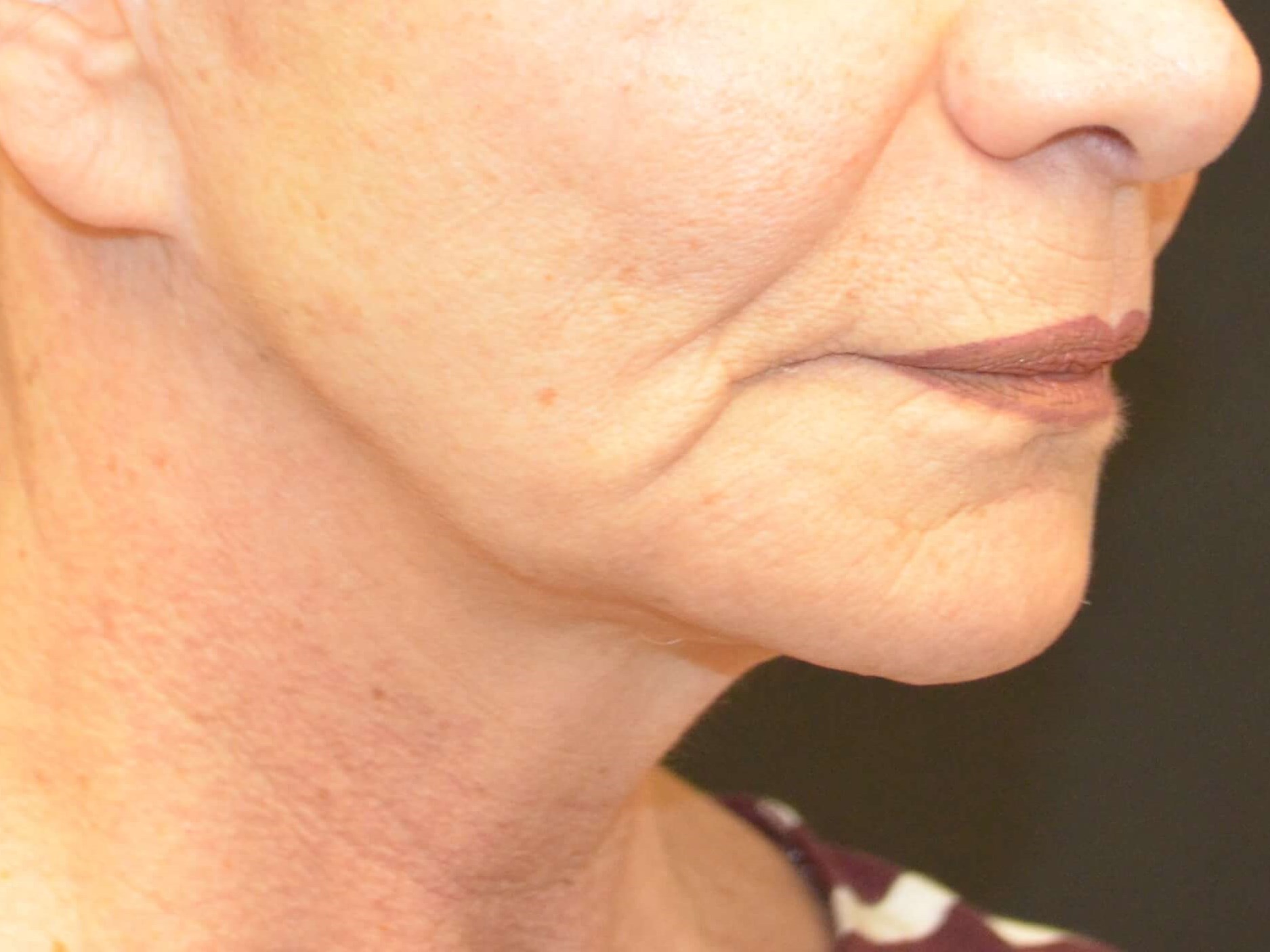 Lower Face & Neck Lift Before