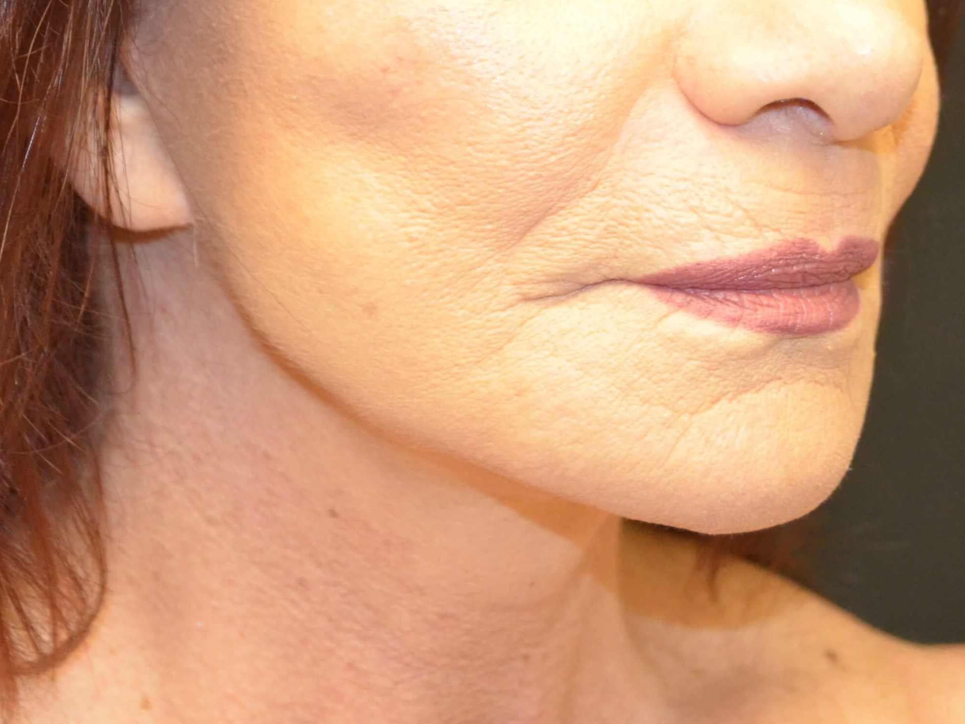 Lower Face & Neck Lift After