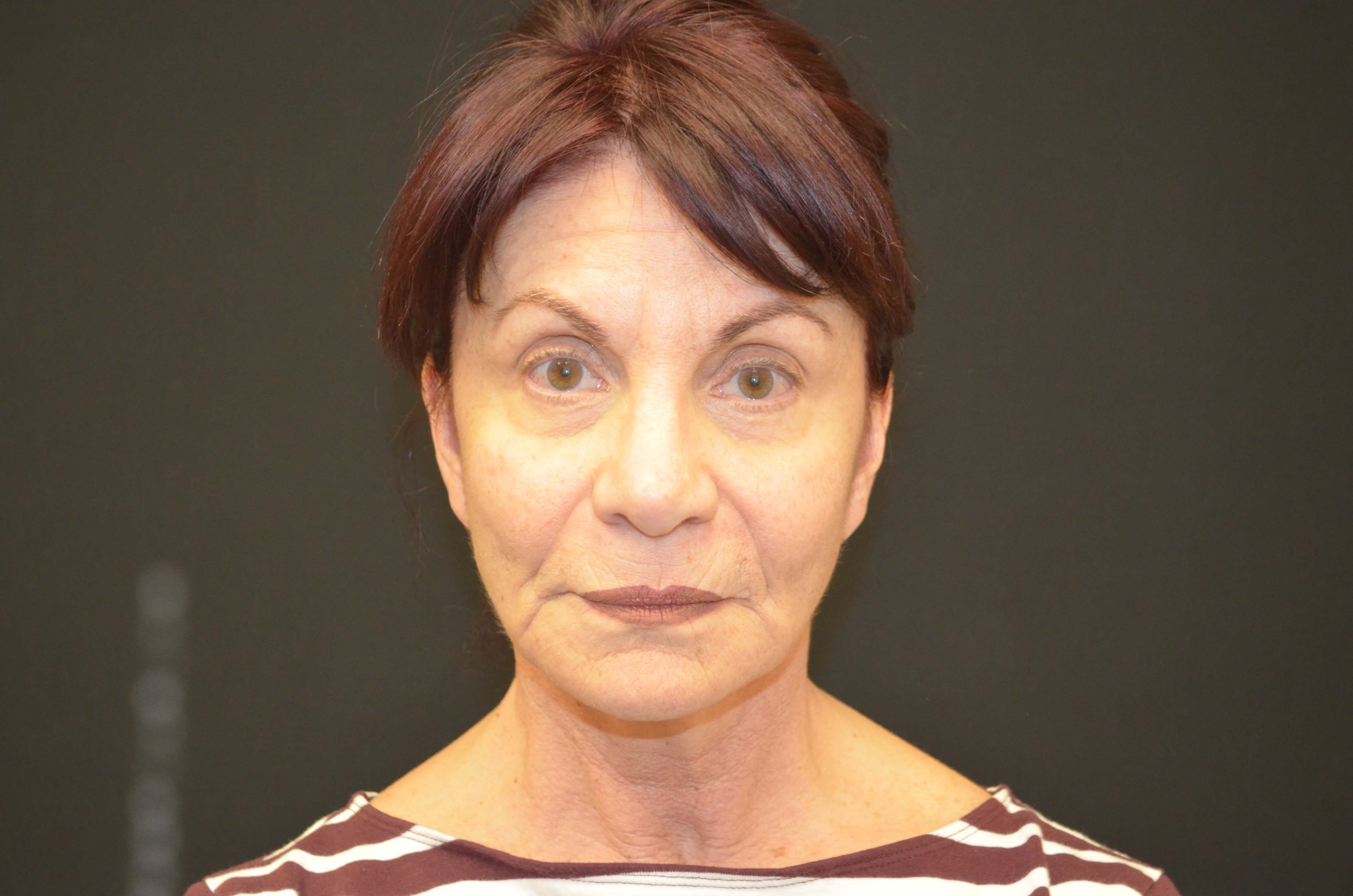 Lower Face & Neck Lift Before