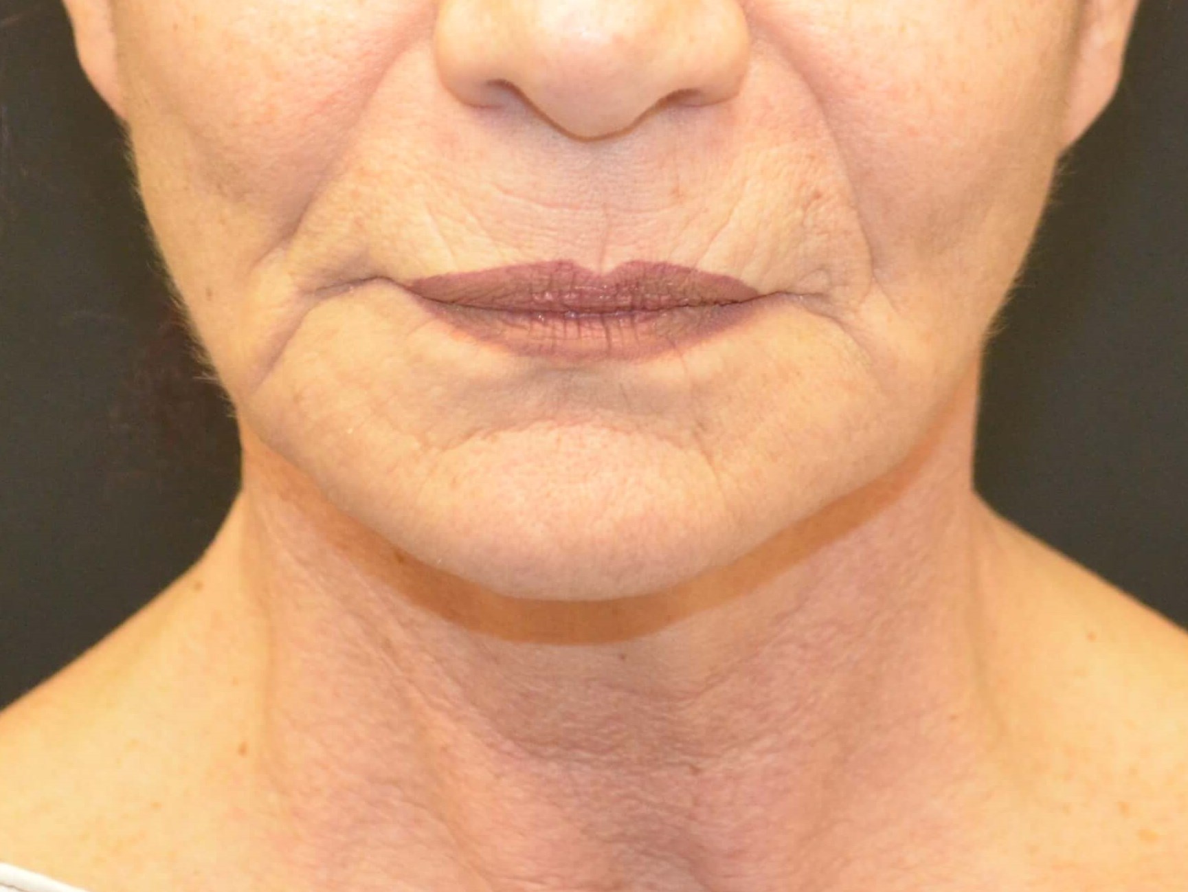 Lower Face & Neck Lift Before