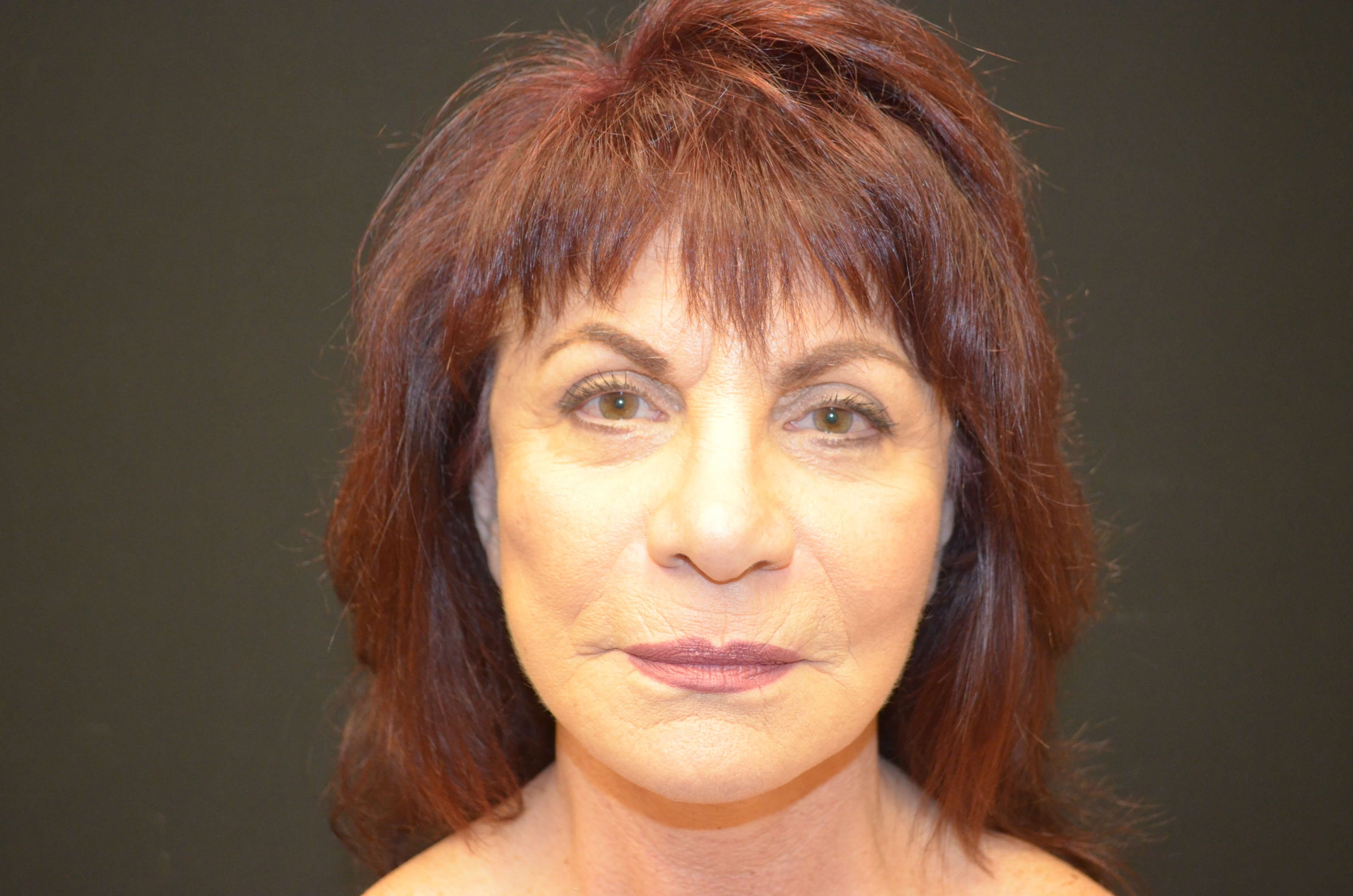 Lower Face & Neck Lift After