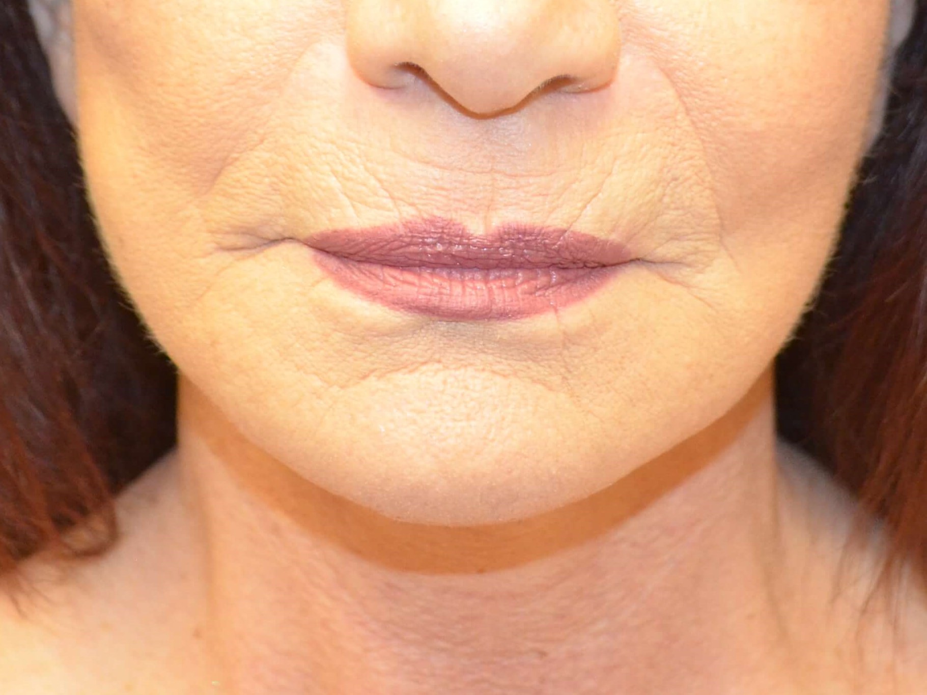 Lower Face & Neck Lift After