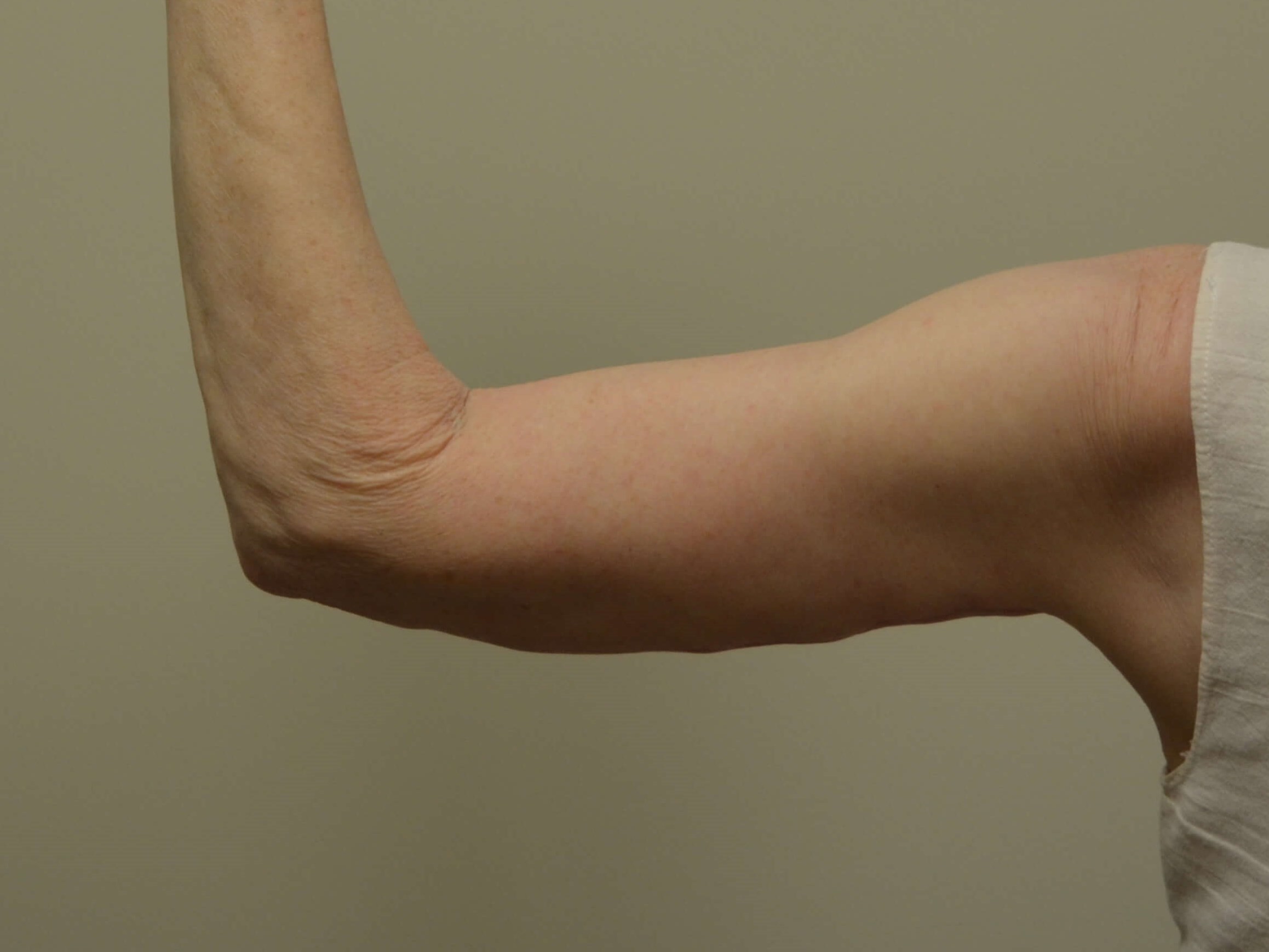 Arm Lift After