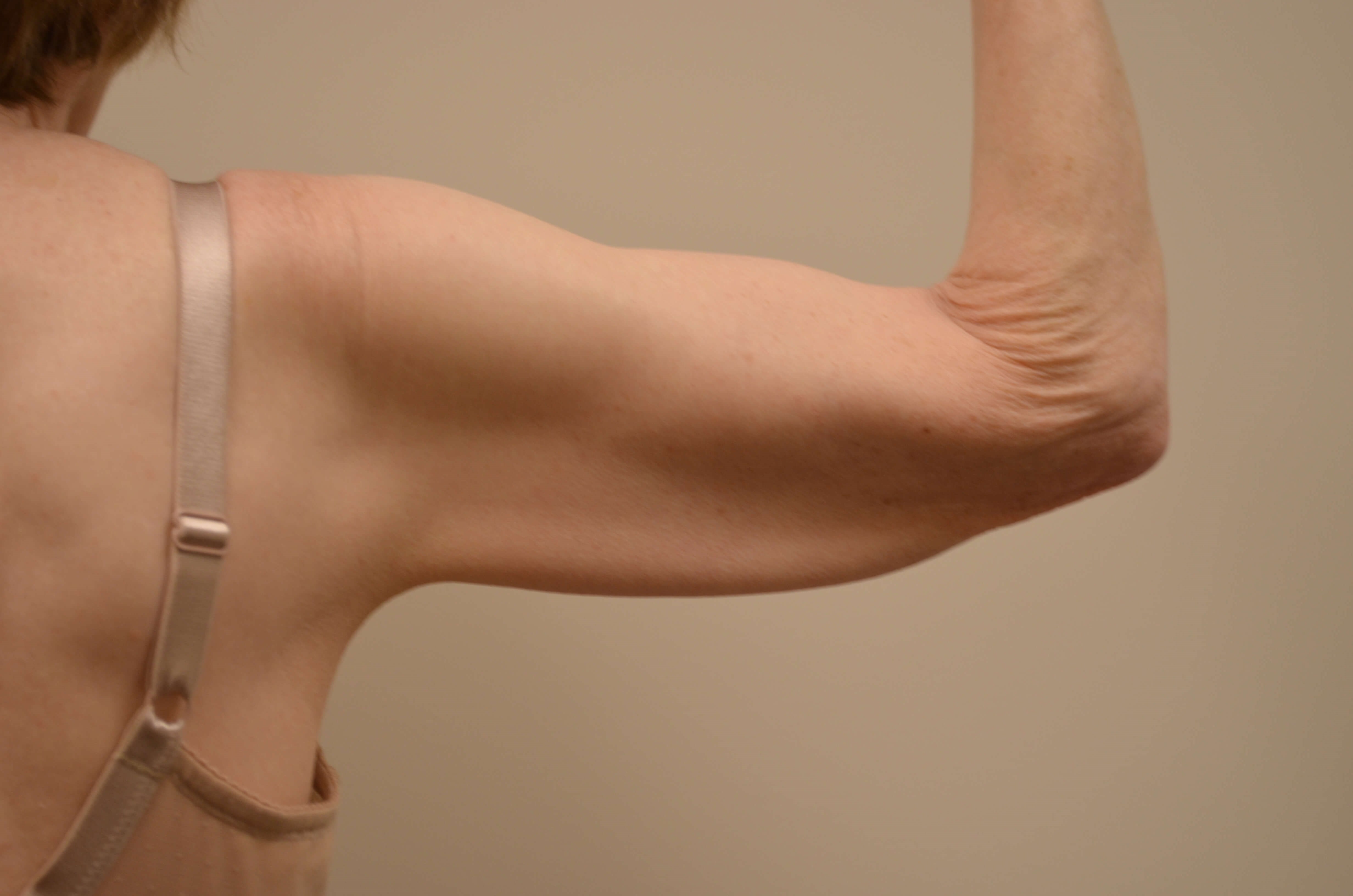 Arm Lift Before