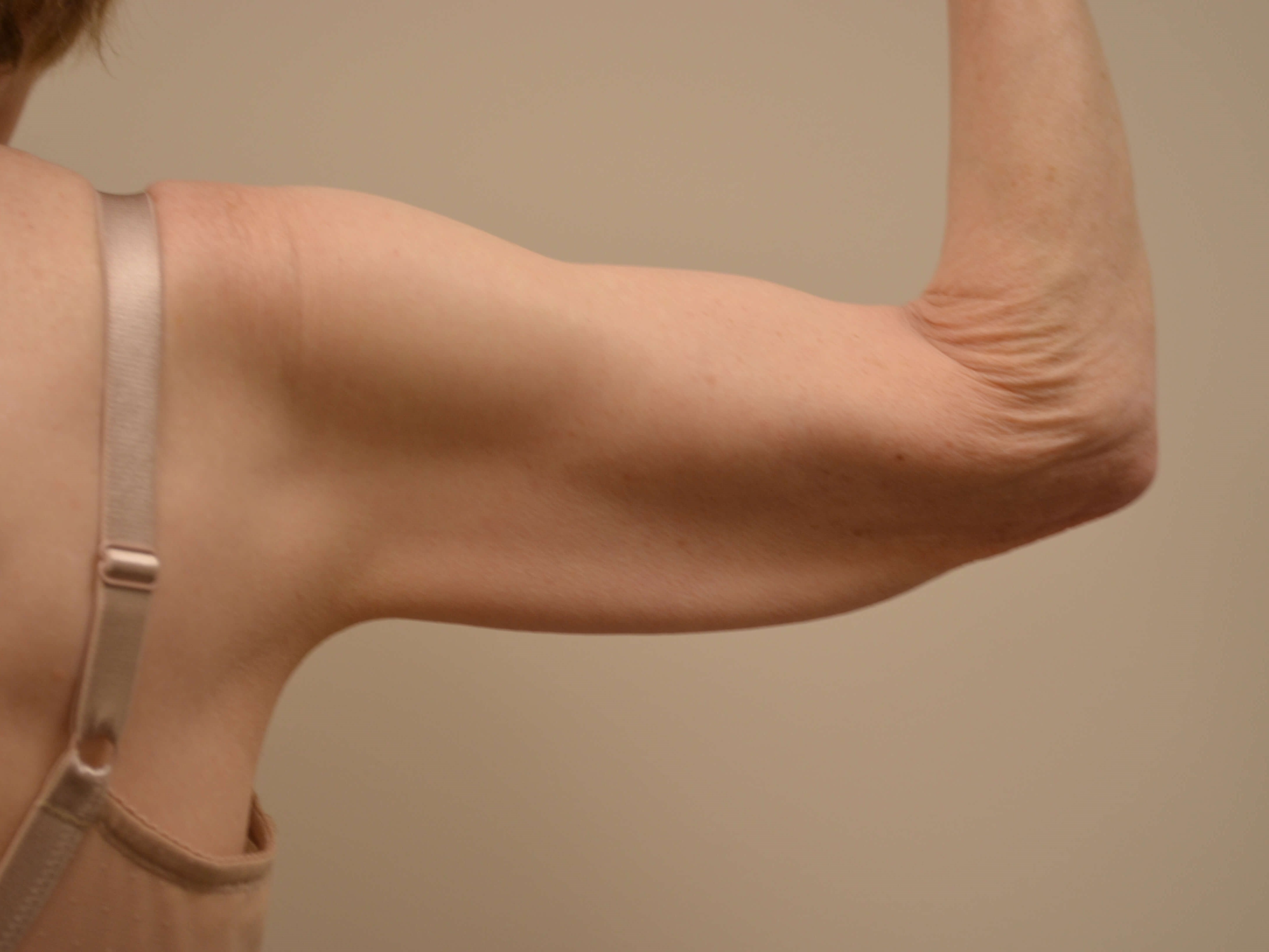 Arm Lift Before