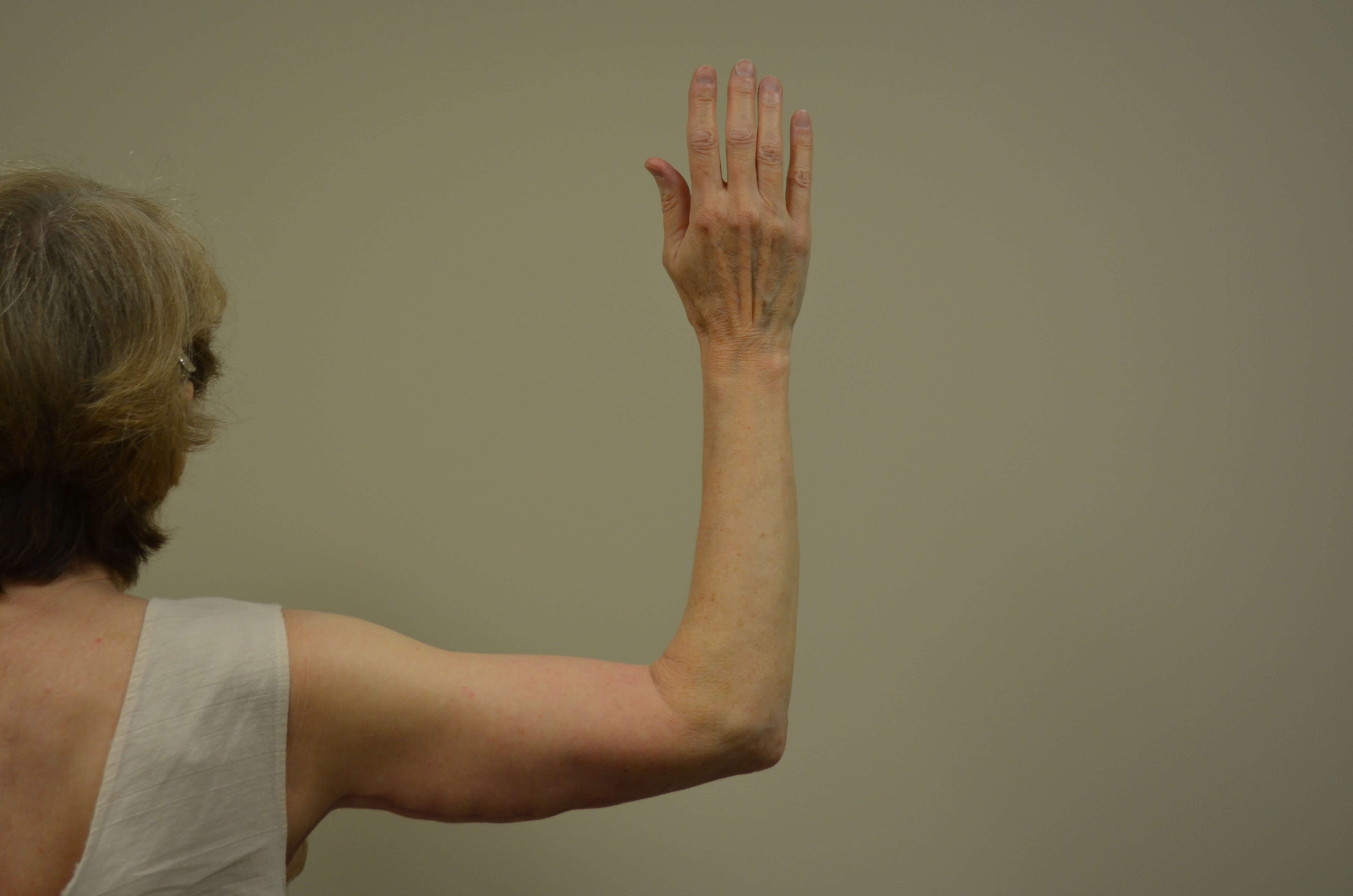 Arm Lift After