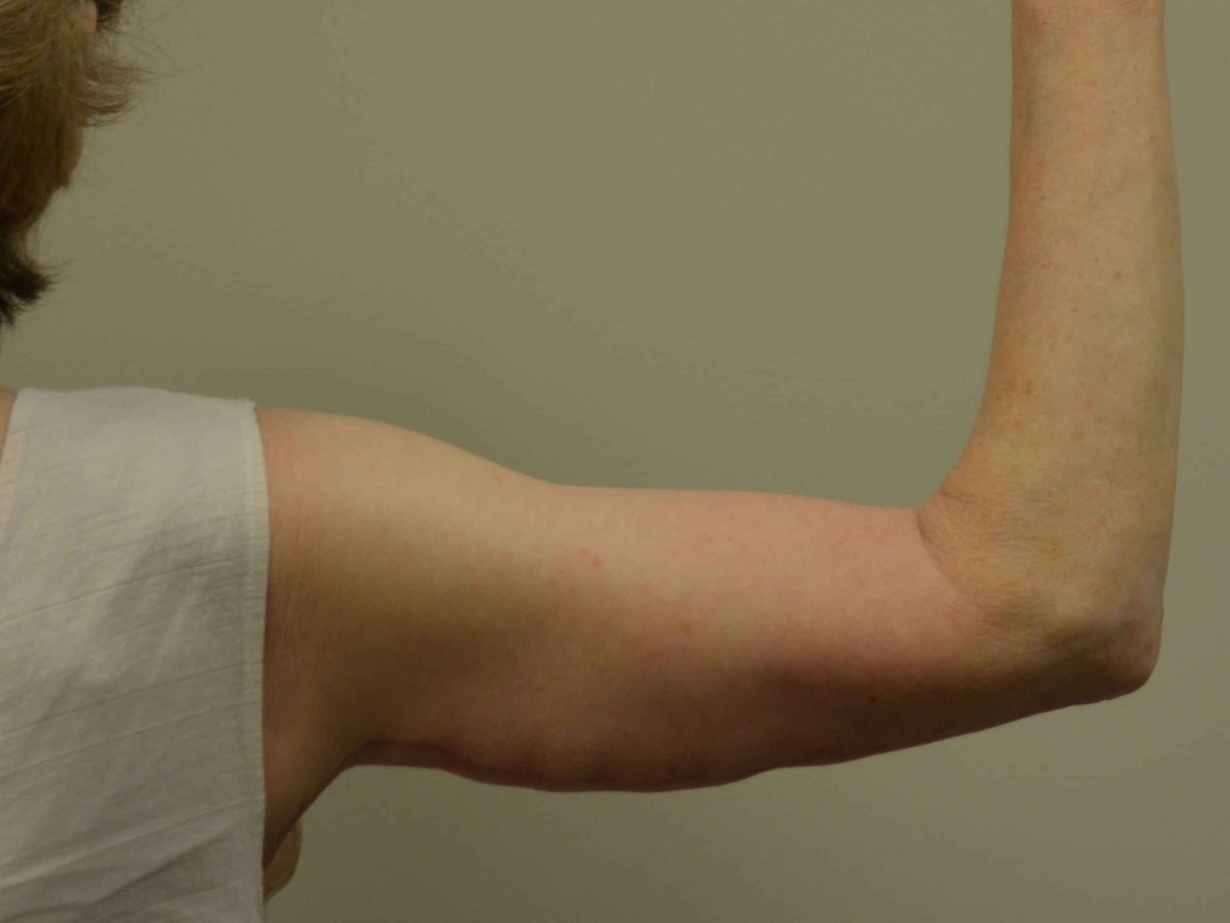 Arm Lift After