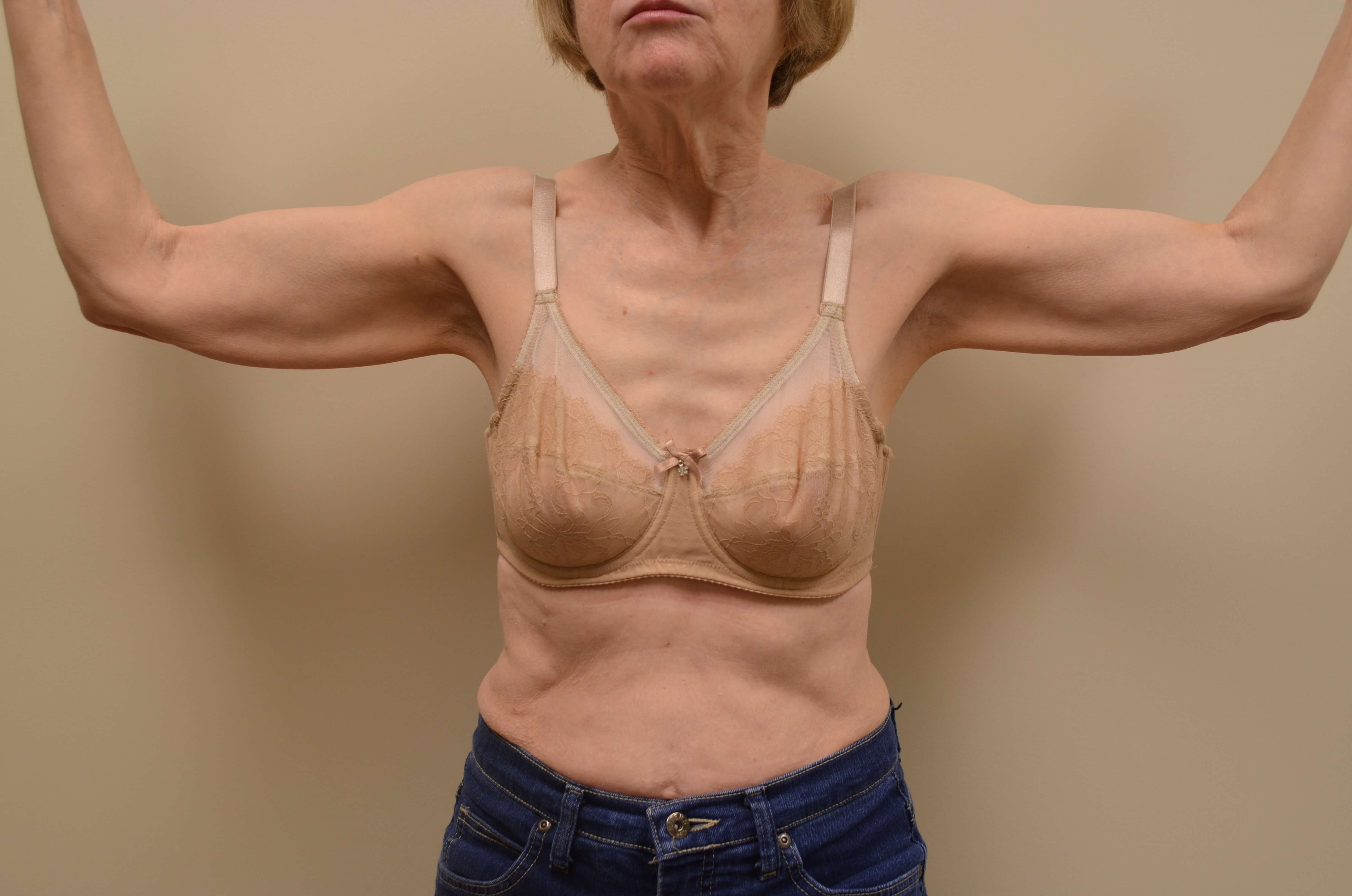Arm Lift Before