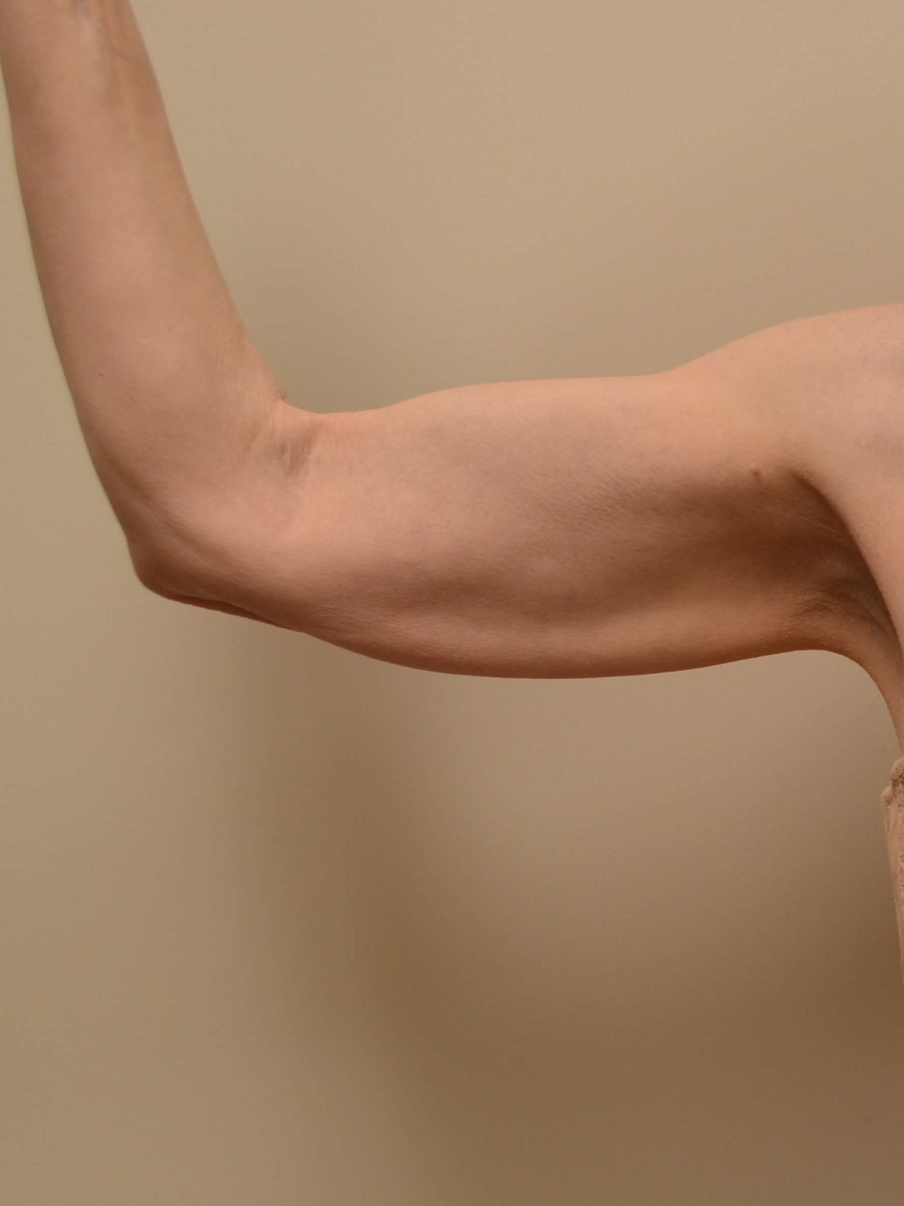 Arm Lift Before
