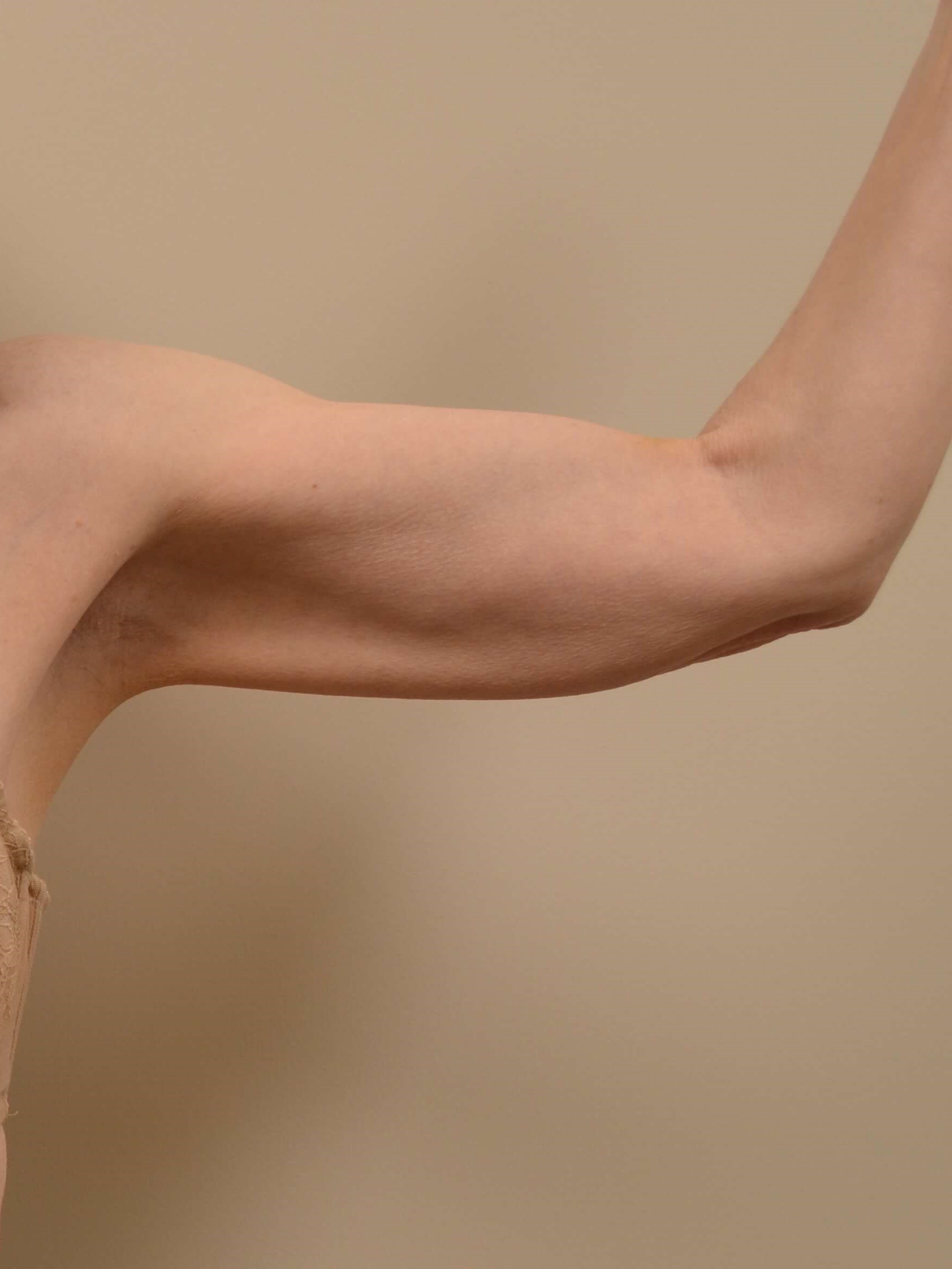 Arm Lift Before