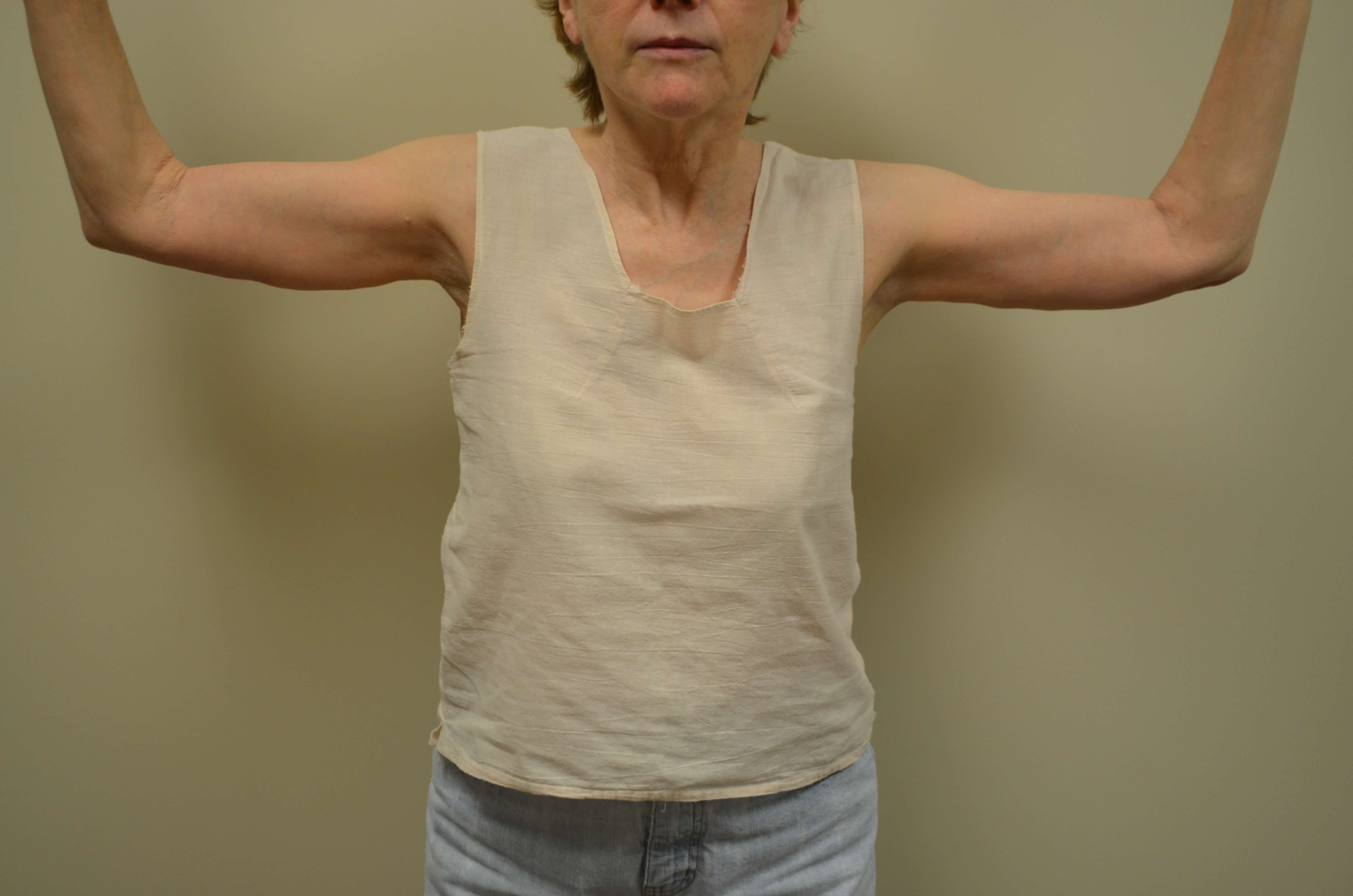 Arm Lift After